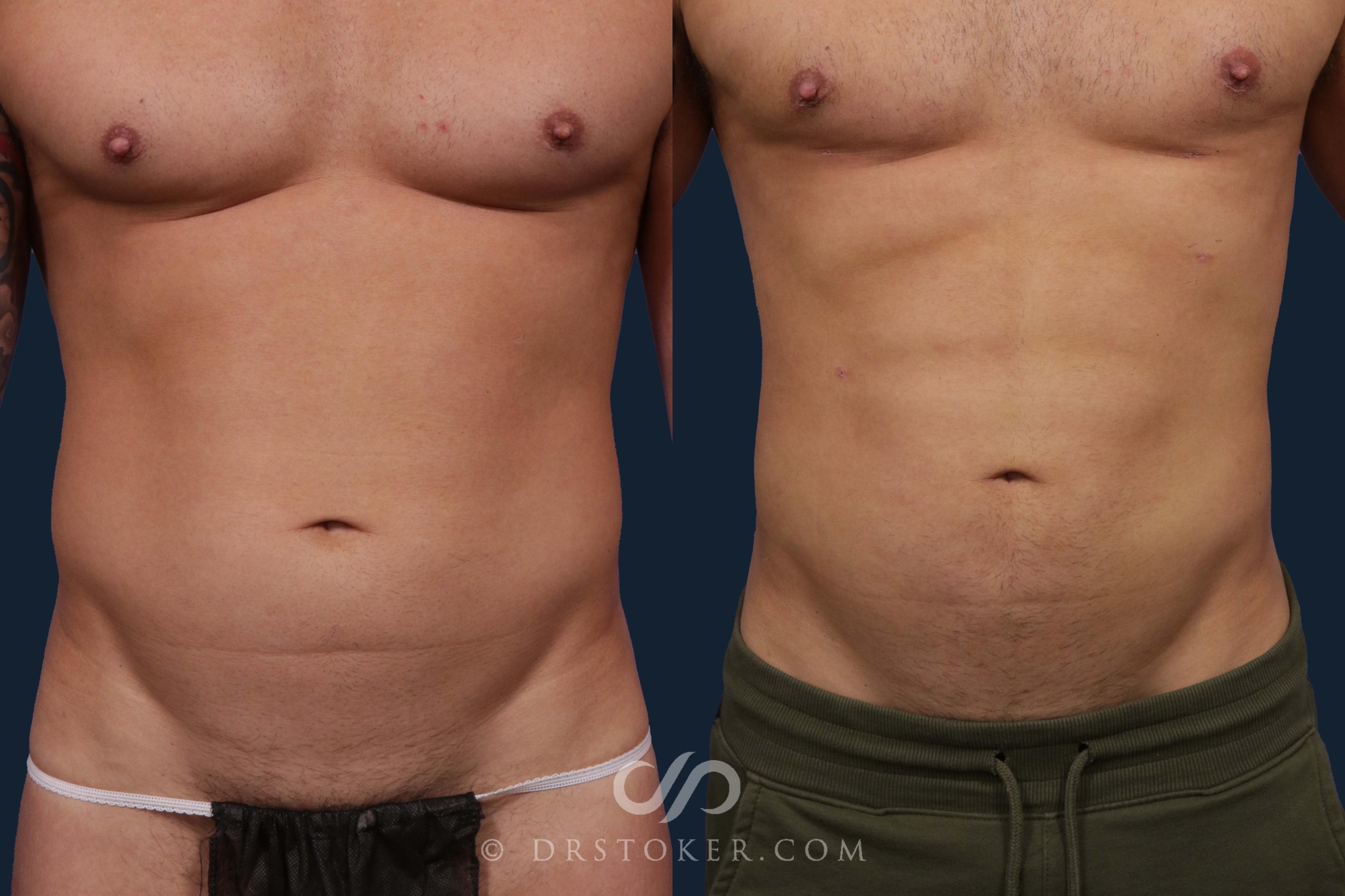 Before & After Liposuction for Men Case 1890 Front View in Los Angeles, CA