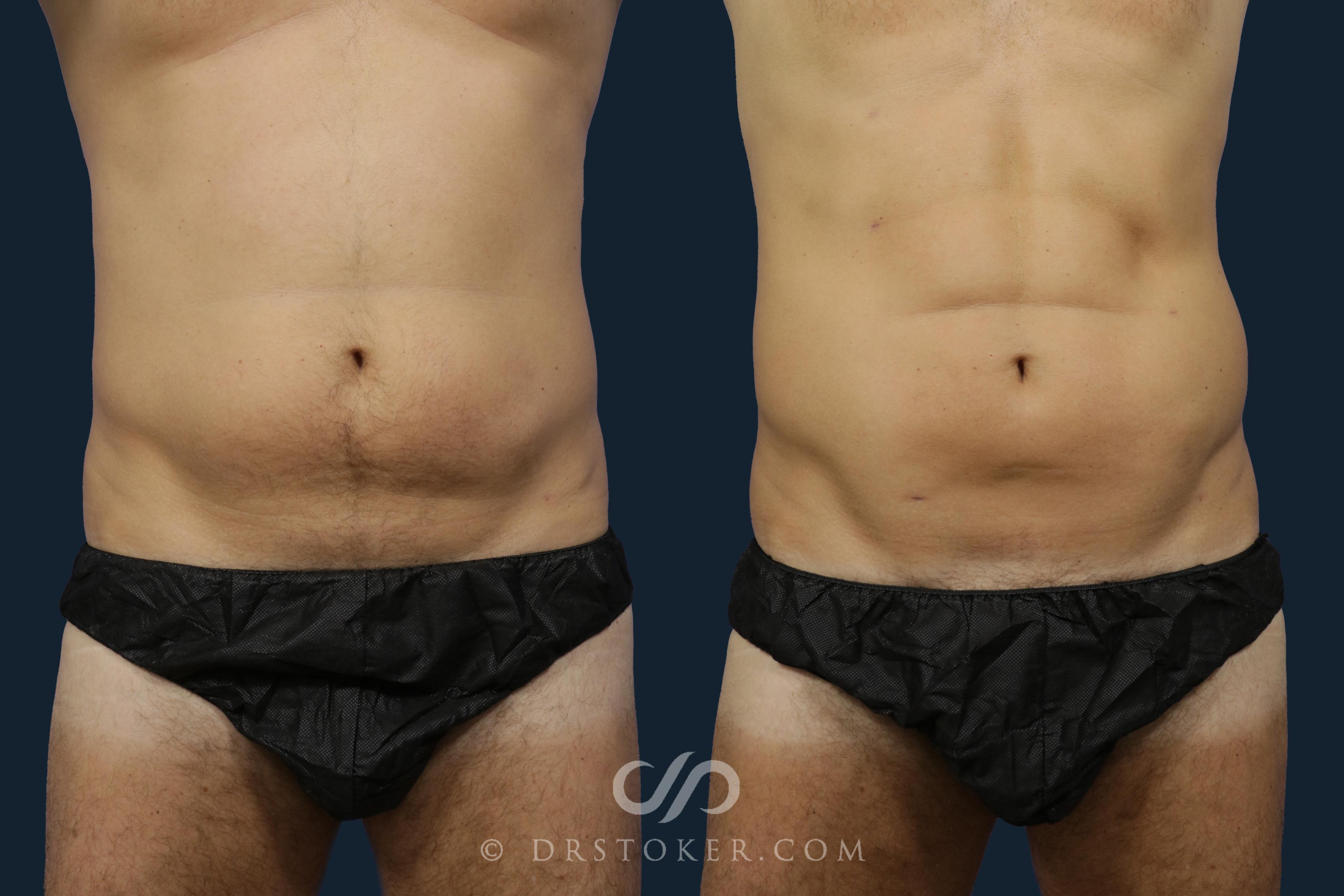 Before & After Liposuction for Men Case 1978 Front View in Los Angeles, CA