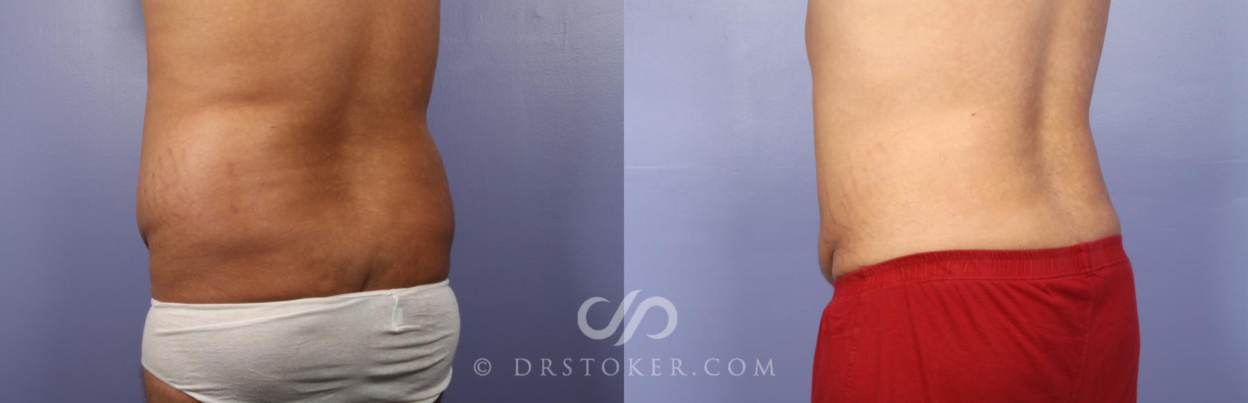 Before & After Liposuction Case 477 View #3 View in Los Angeles, CA