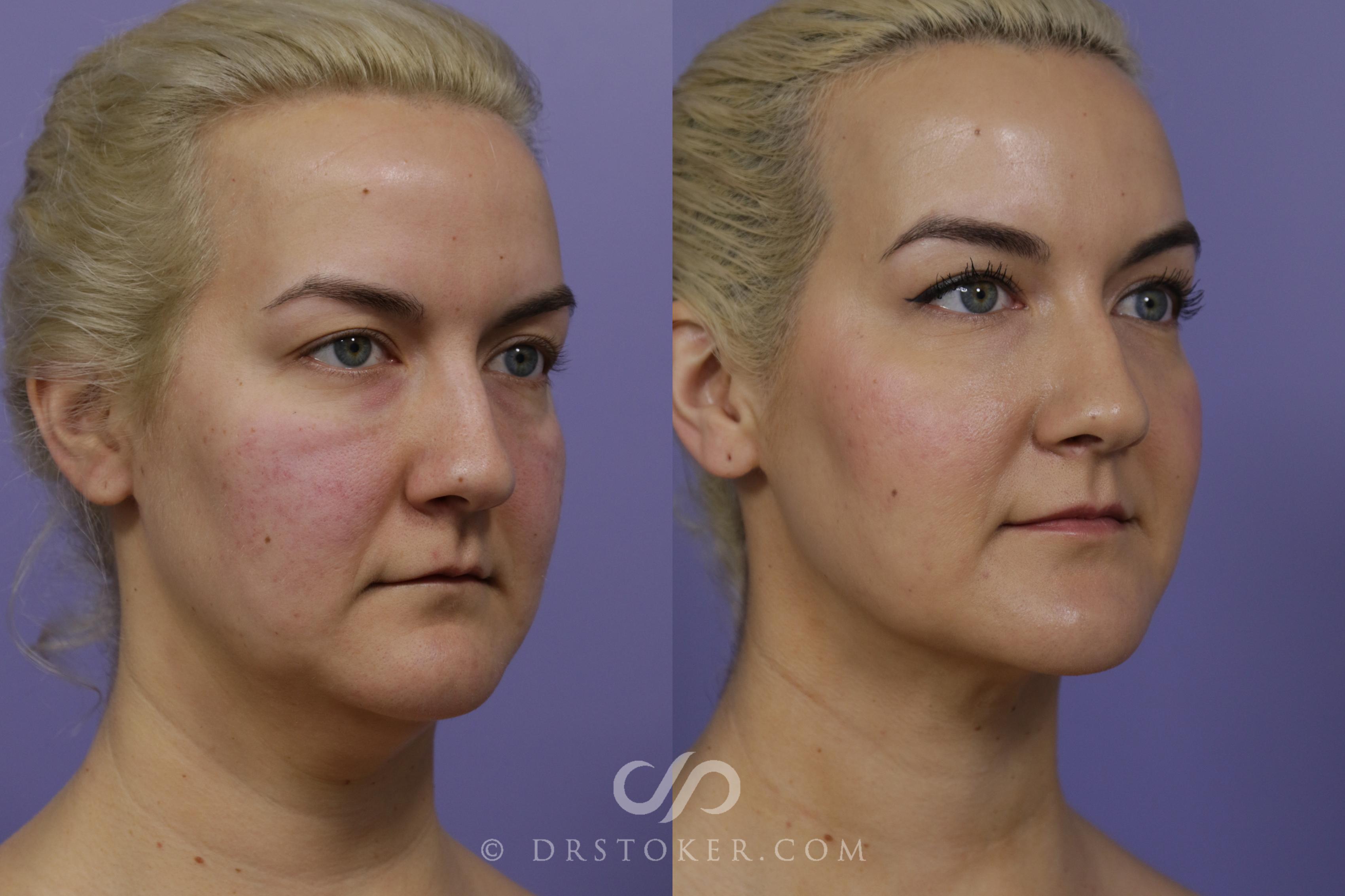 Before & After Liposuction - Neck Case 1461 View #2 View in Los Angeles, CA