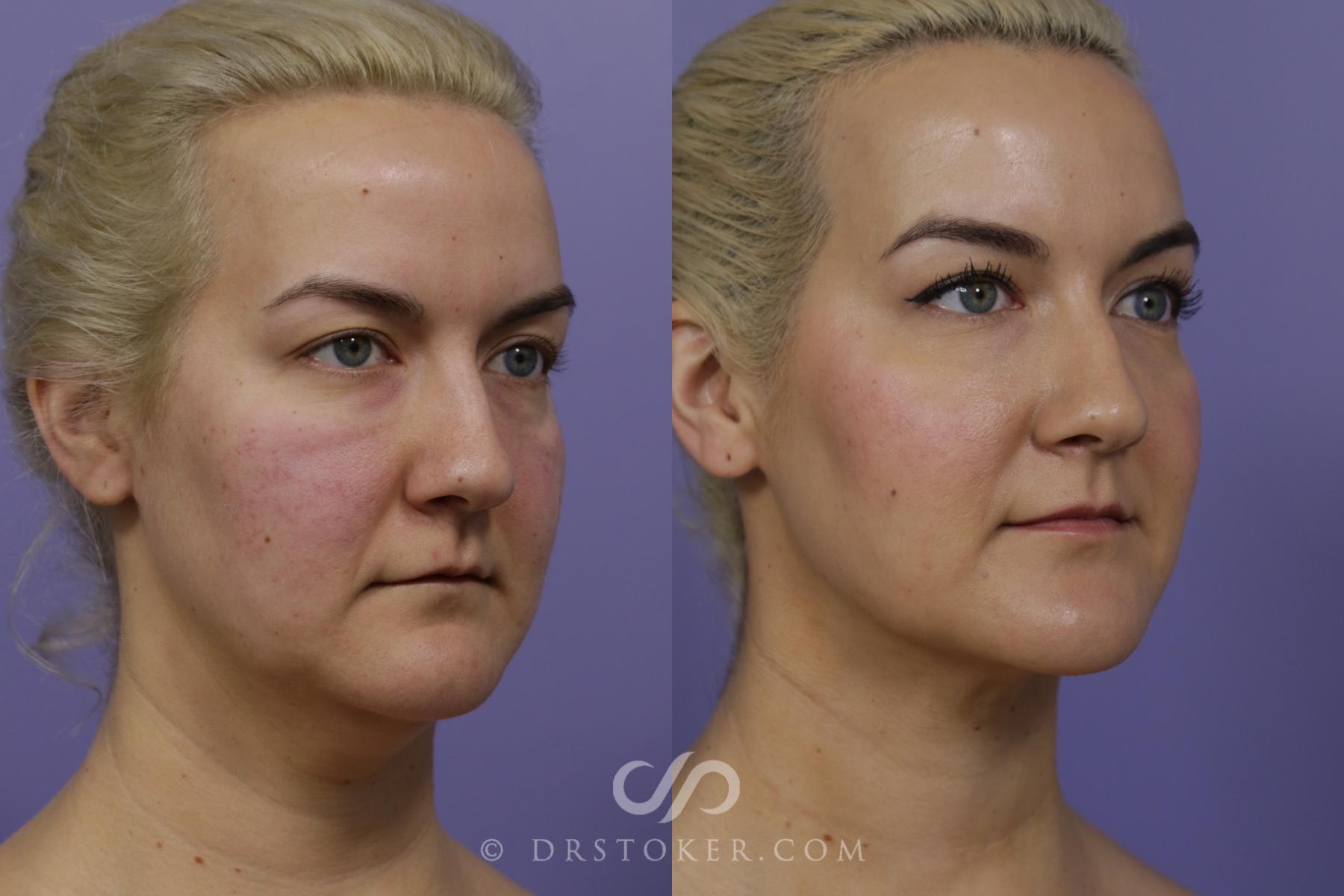 Before & After Liposuction - Neck Case 1461 View #2 View in Los Angeles, CA