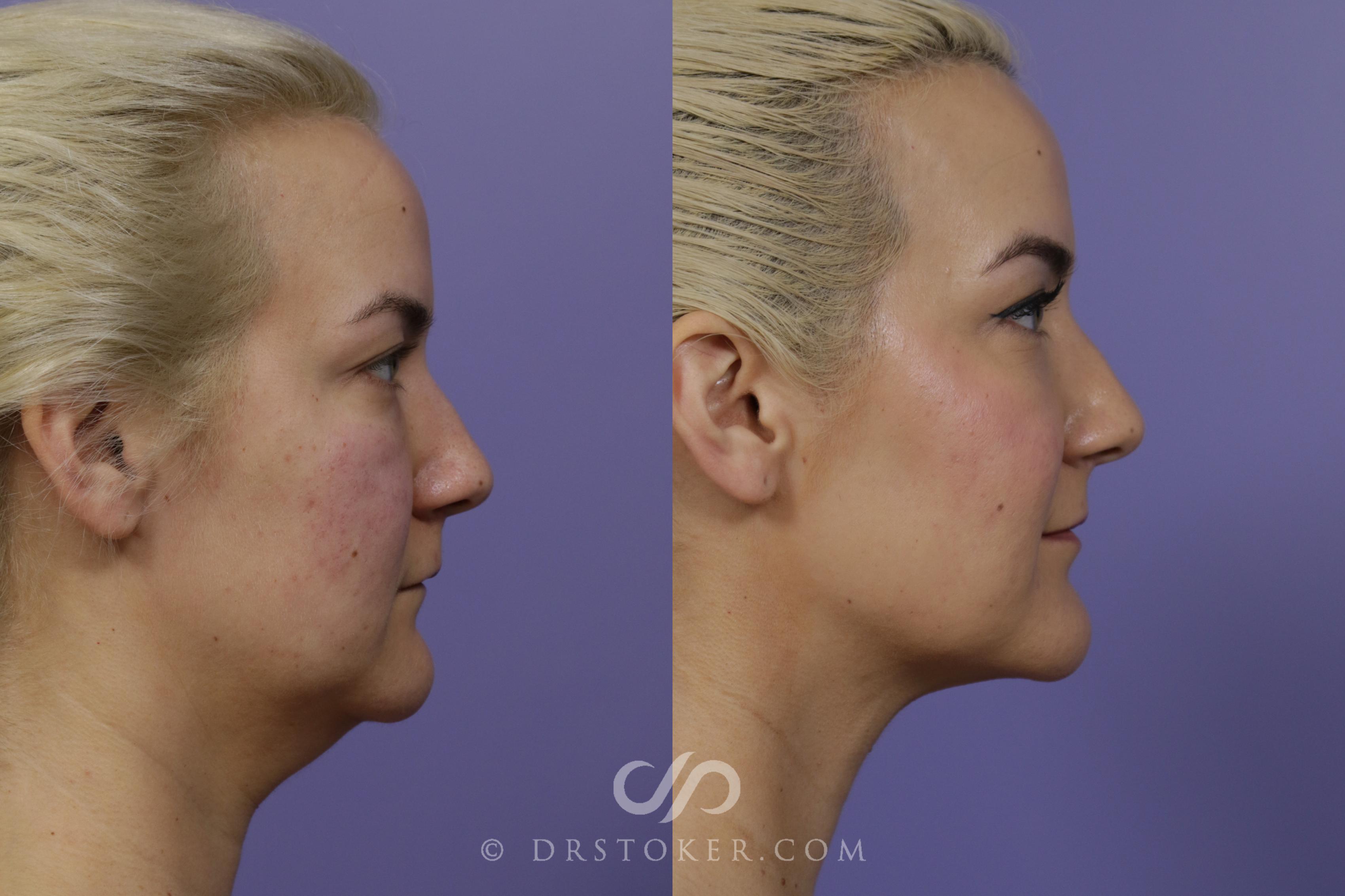 Before & After Liposuction - Neck Case 1461 View #3 View in Los Angeles, CA