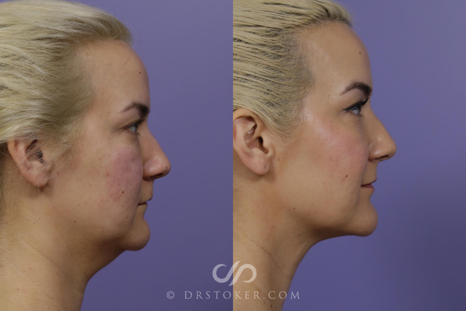 Before & After Liposuction - Neck Case 1461 View #3 View in Los Angeles, CA
