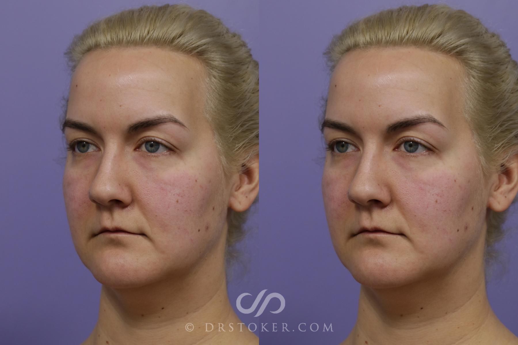 Before & After Liposuction - Neck Case 1461 View #4 View in Los Angeles, CA