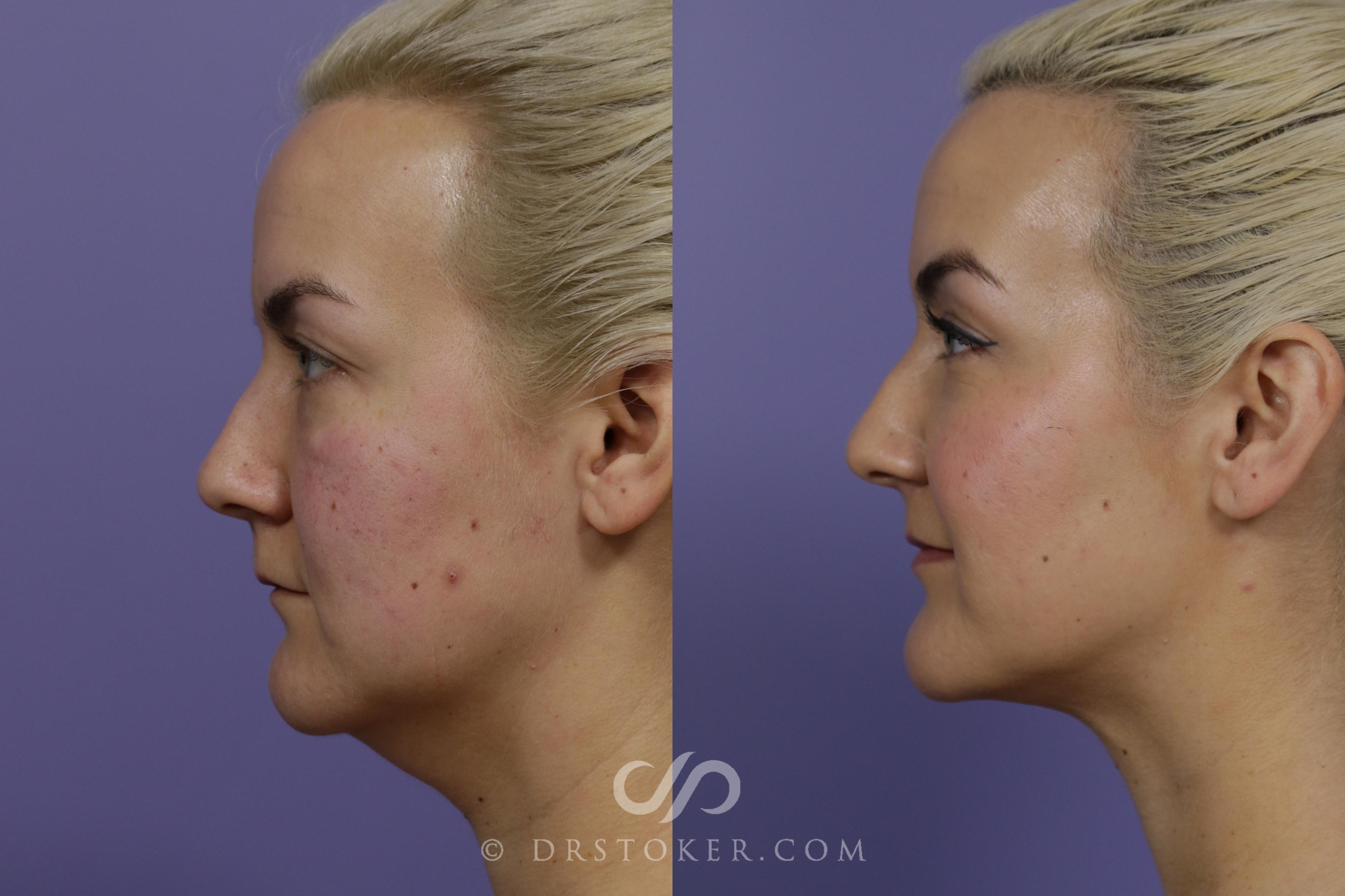 Before & After Liposuction - Neck Case 1461 View #5 View in Los Angeles, CA