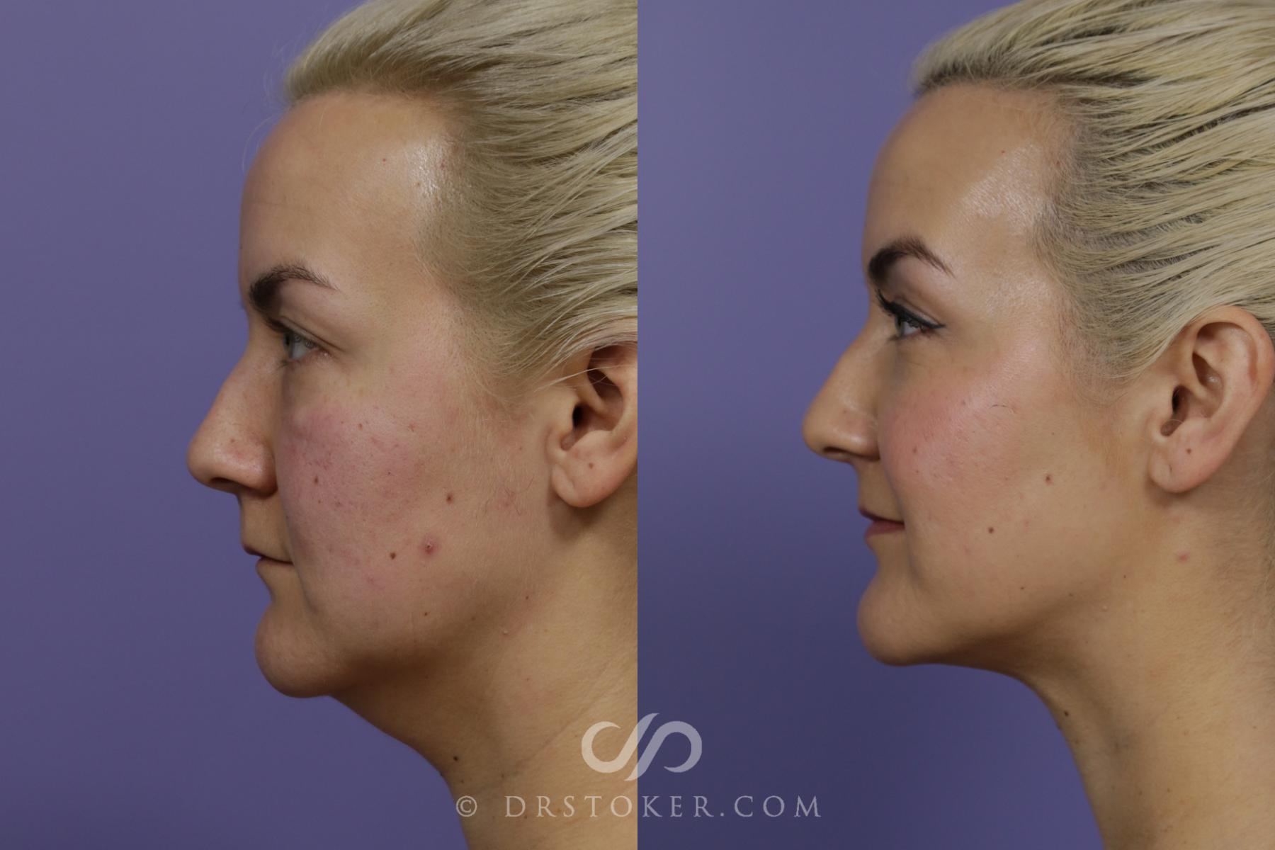 Before & After Liposuction - Neck Case 1461 View #5 View in Los Angeles, CA