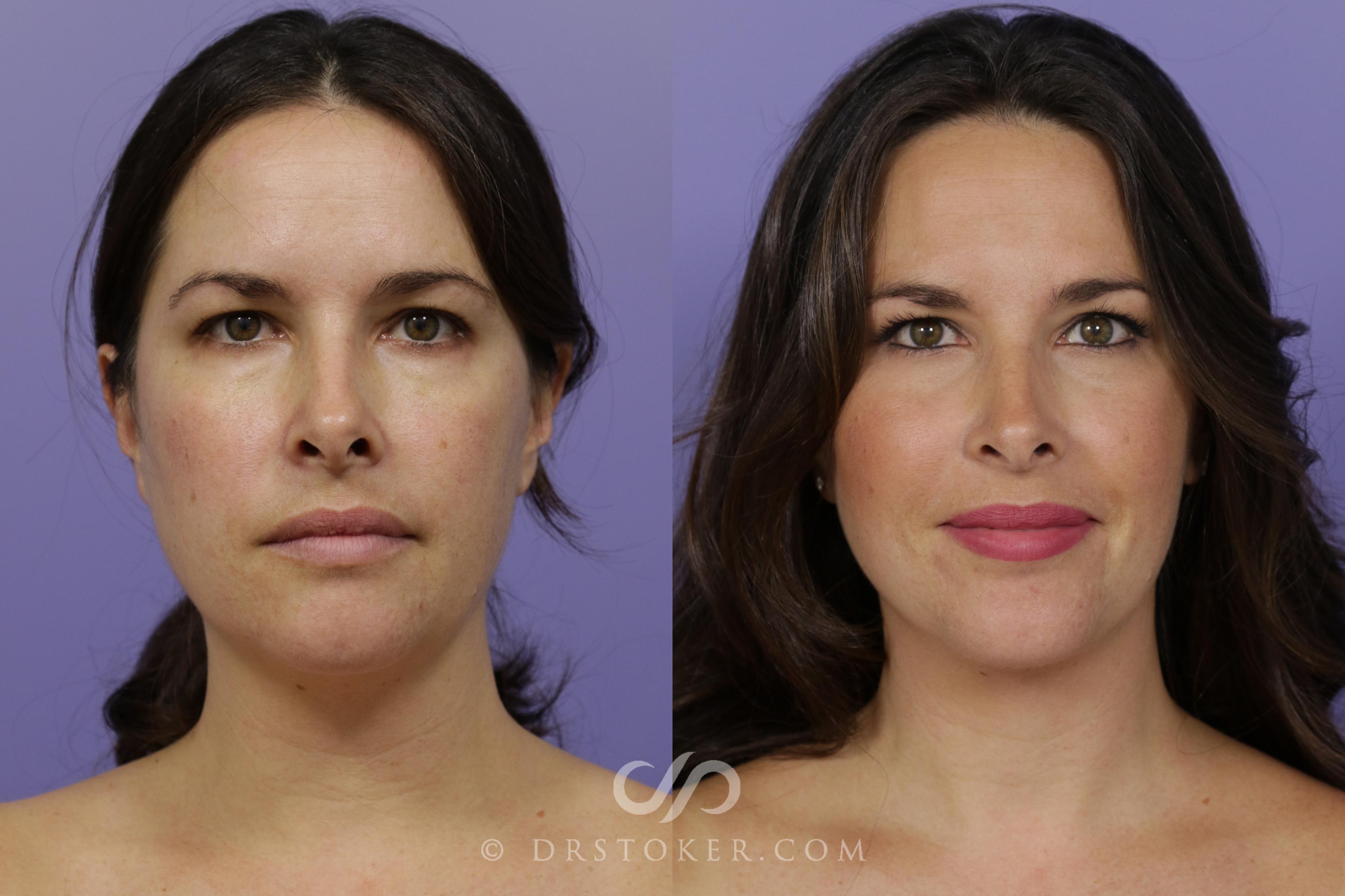 Before & After Liposuction - Neck Case 1561 View #1 View in Marina del Rey, CA