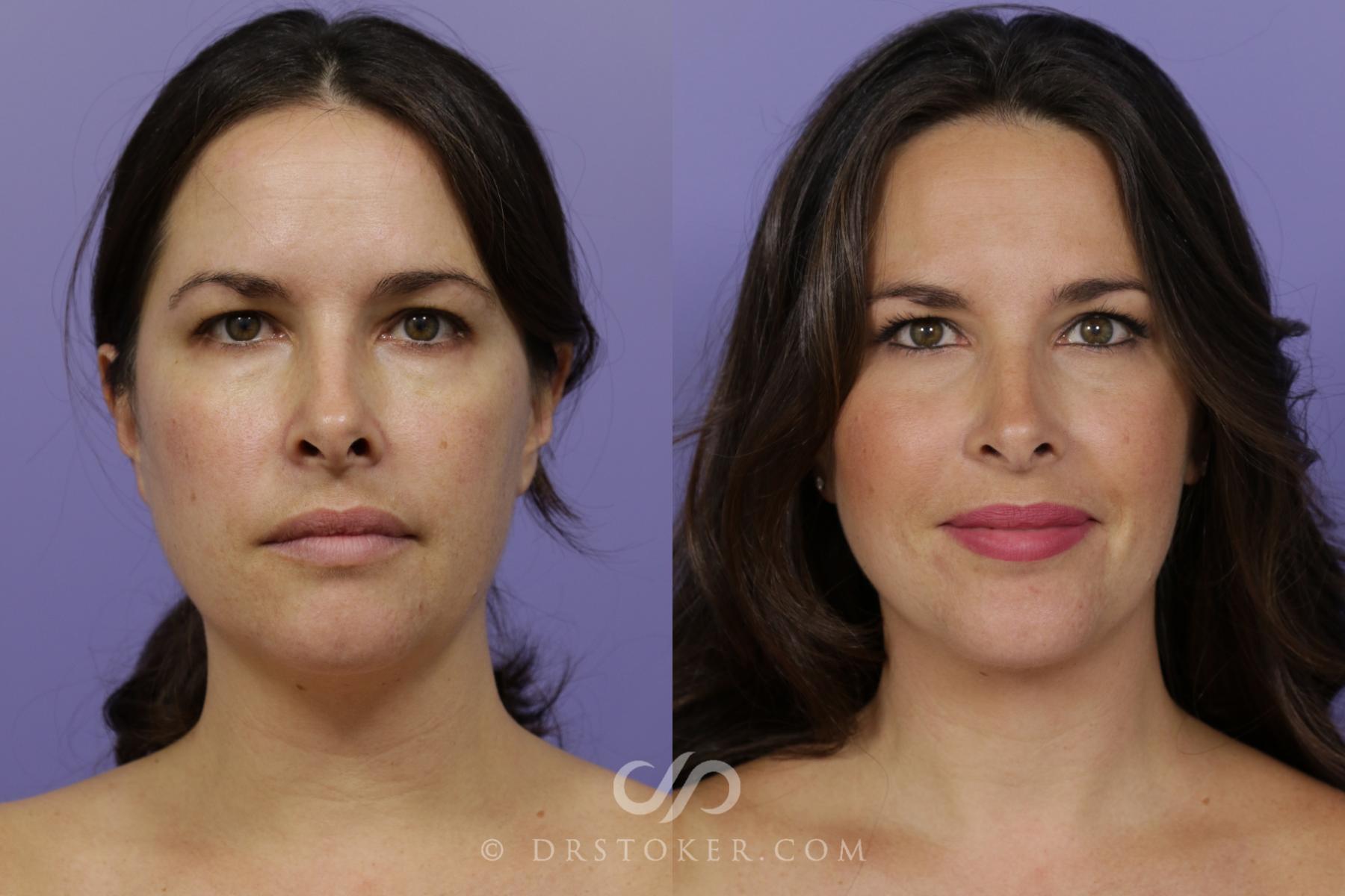 Before & After Liposuction - Neck Case 1561 View #1 View in Los Angeles, CA