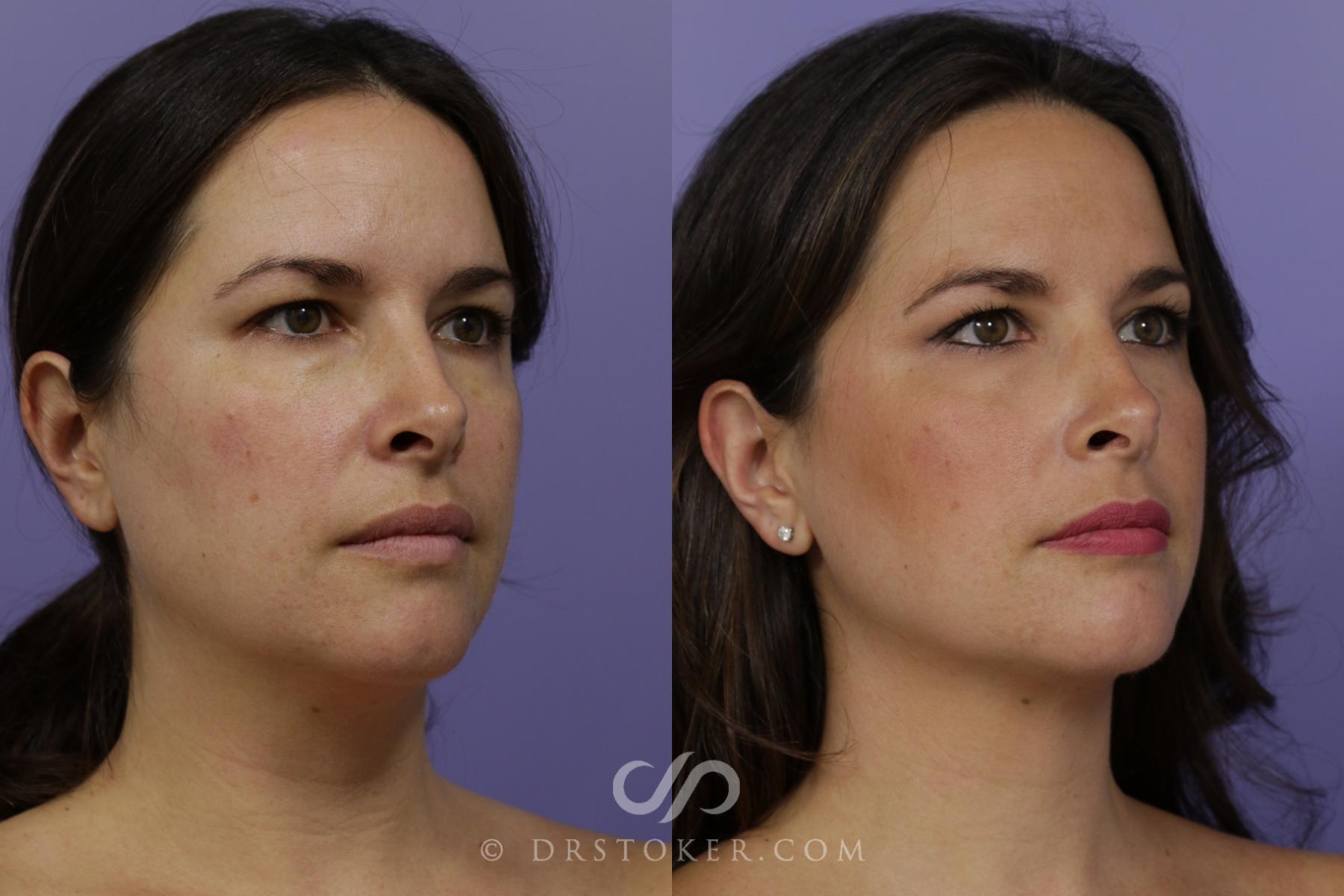 Before & After Liposuction - Neck Case 1561 View #2 View in Los Angeles, CA