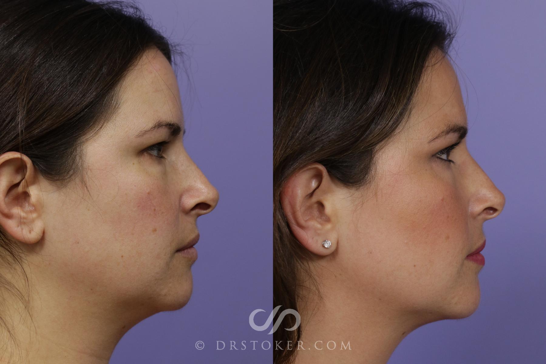 Before & After Liposuction - Neck Case 1561 View #3 View in Los Angeles, CA