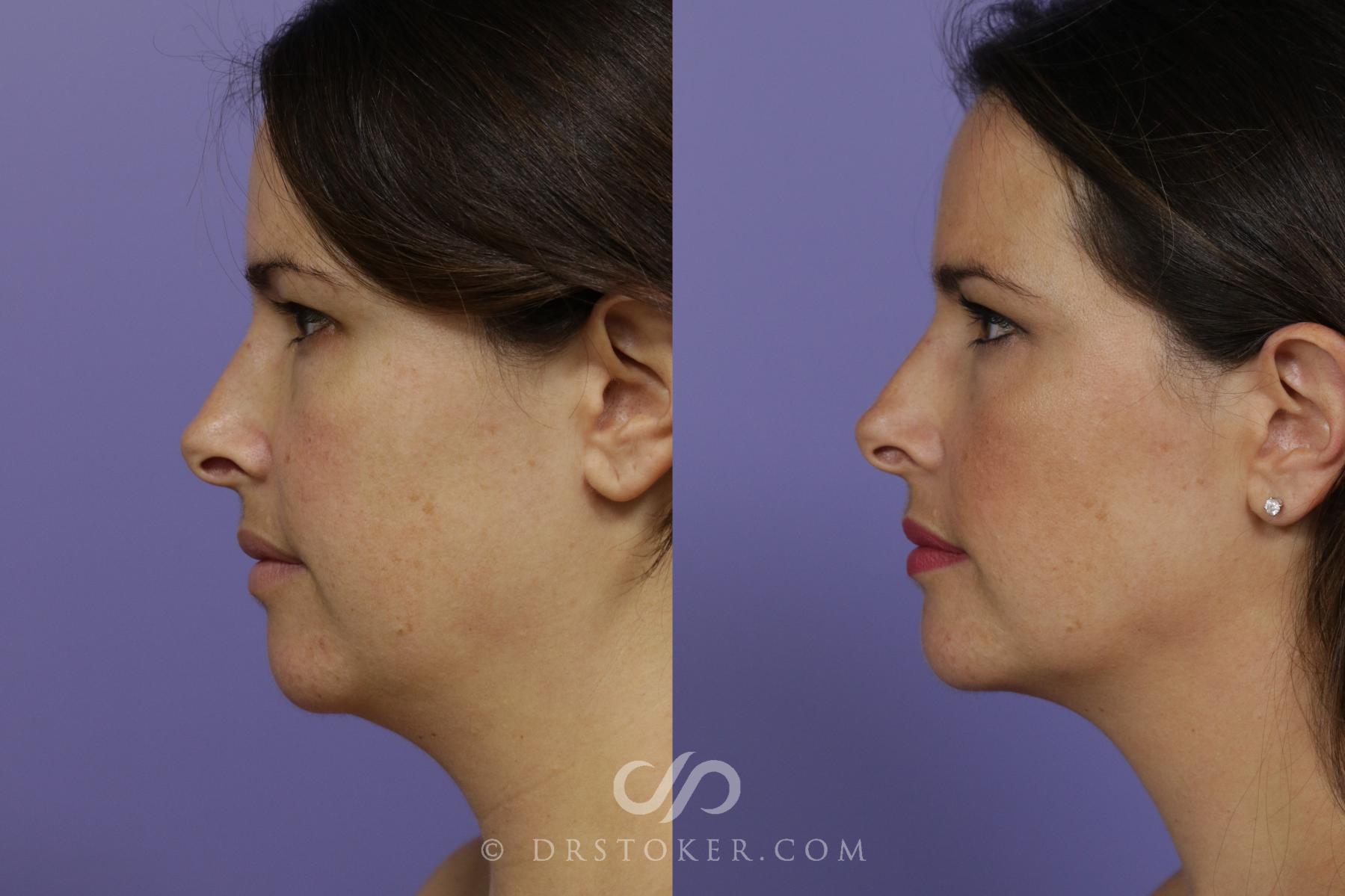 Before & After Liposuction - Neck Case 1562 View #1 View in Los Angeles, CA