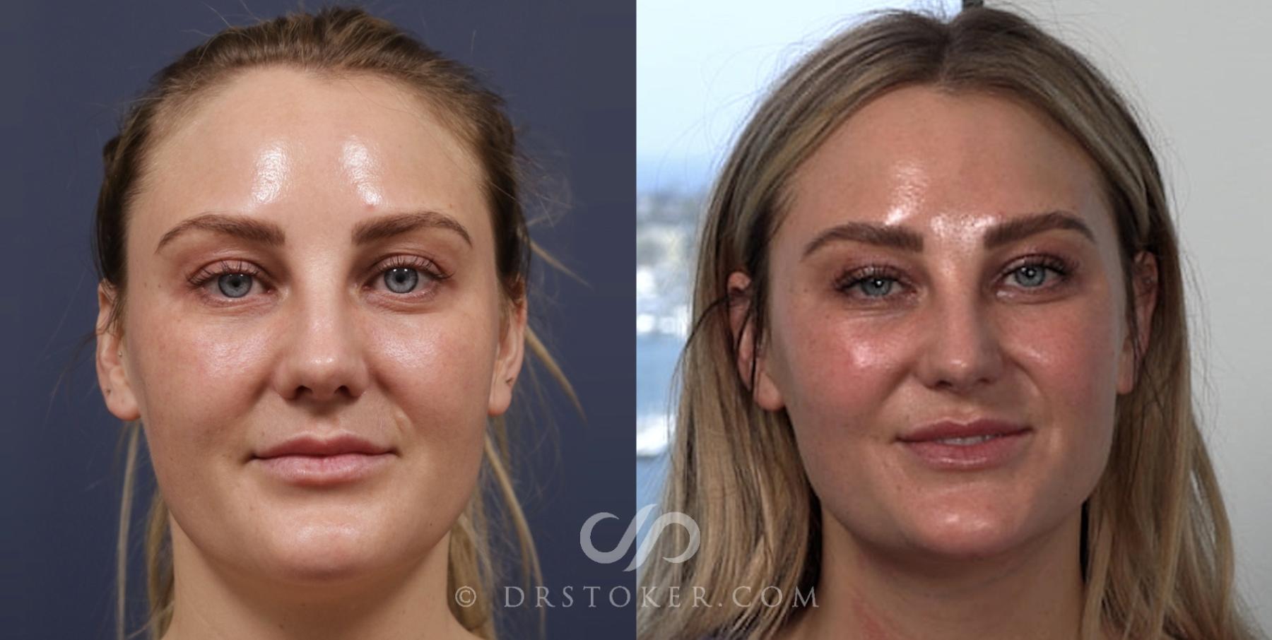 Before & After Liposuction - Neck Case 2025 Front View in Los Angeles, CA