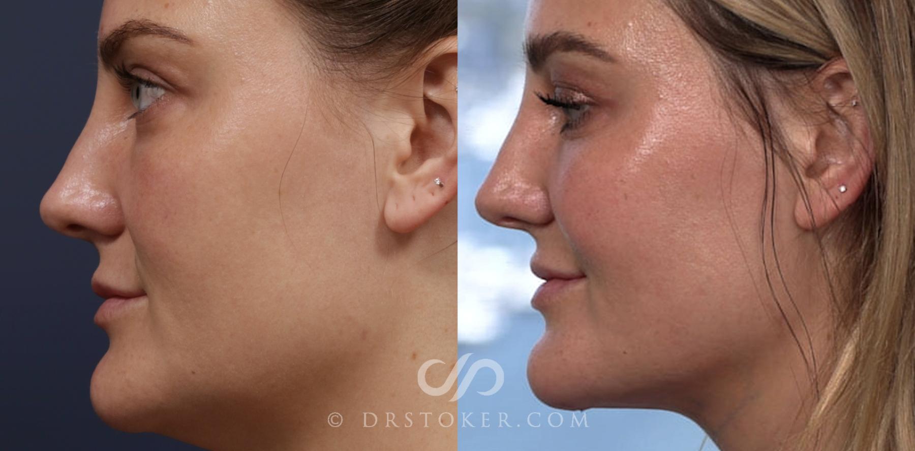 Before & After Liposuction - Neck Case 2025 Left Side View in Los Angeles, CA