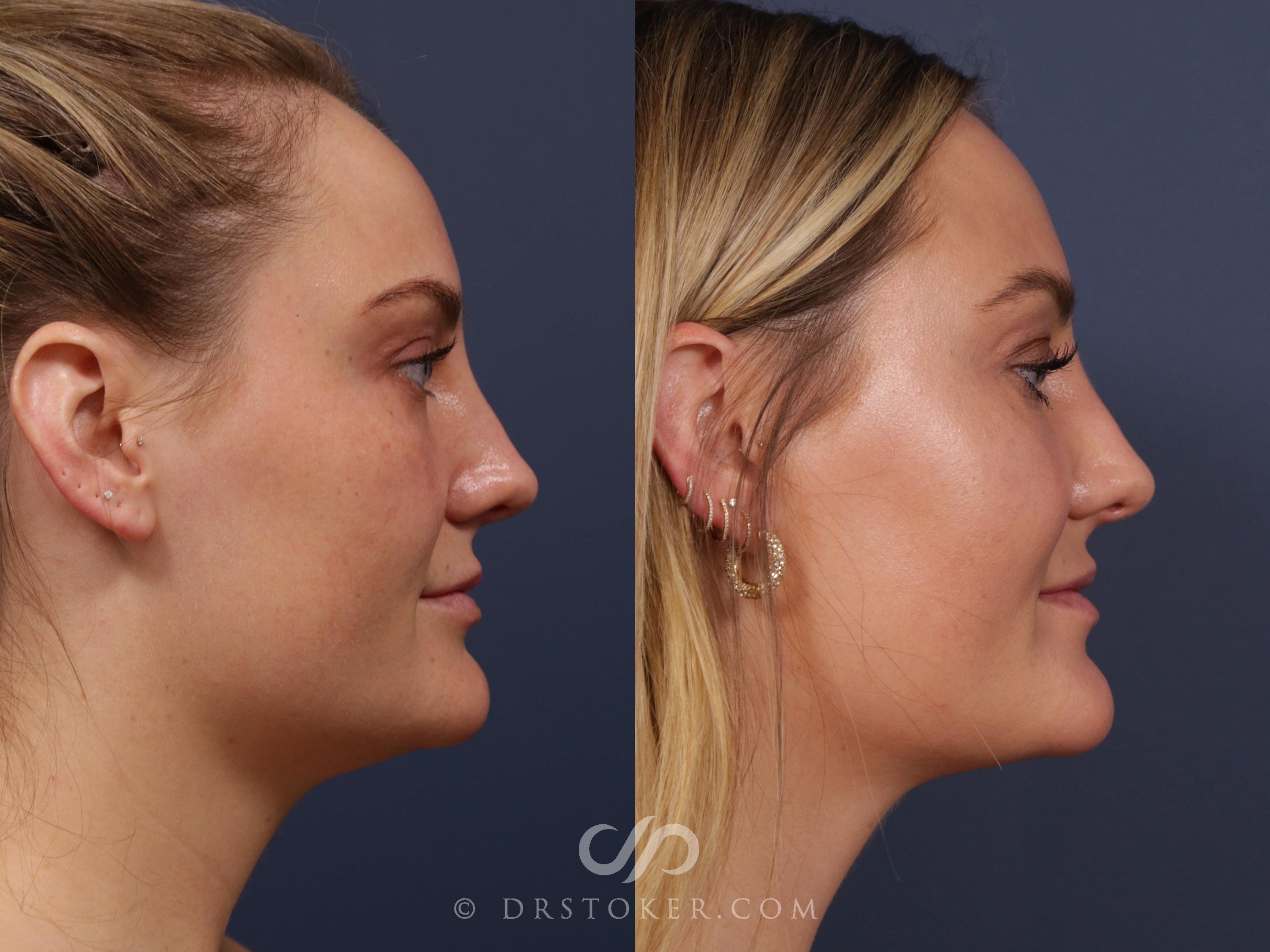 Before & After Liposuction - Neck Case 2025 Right Side View in Los Angeles, CA