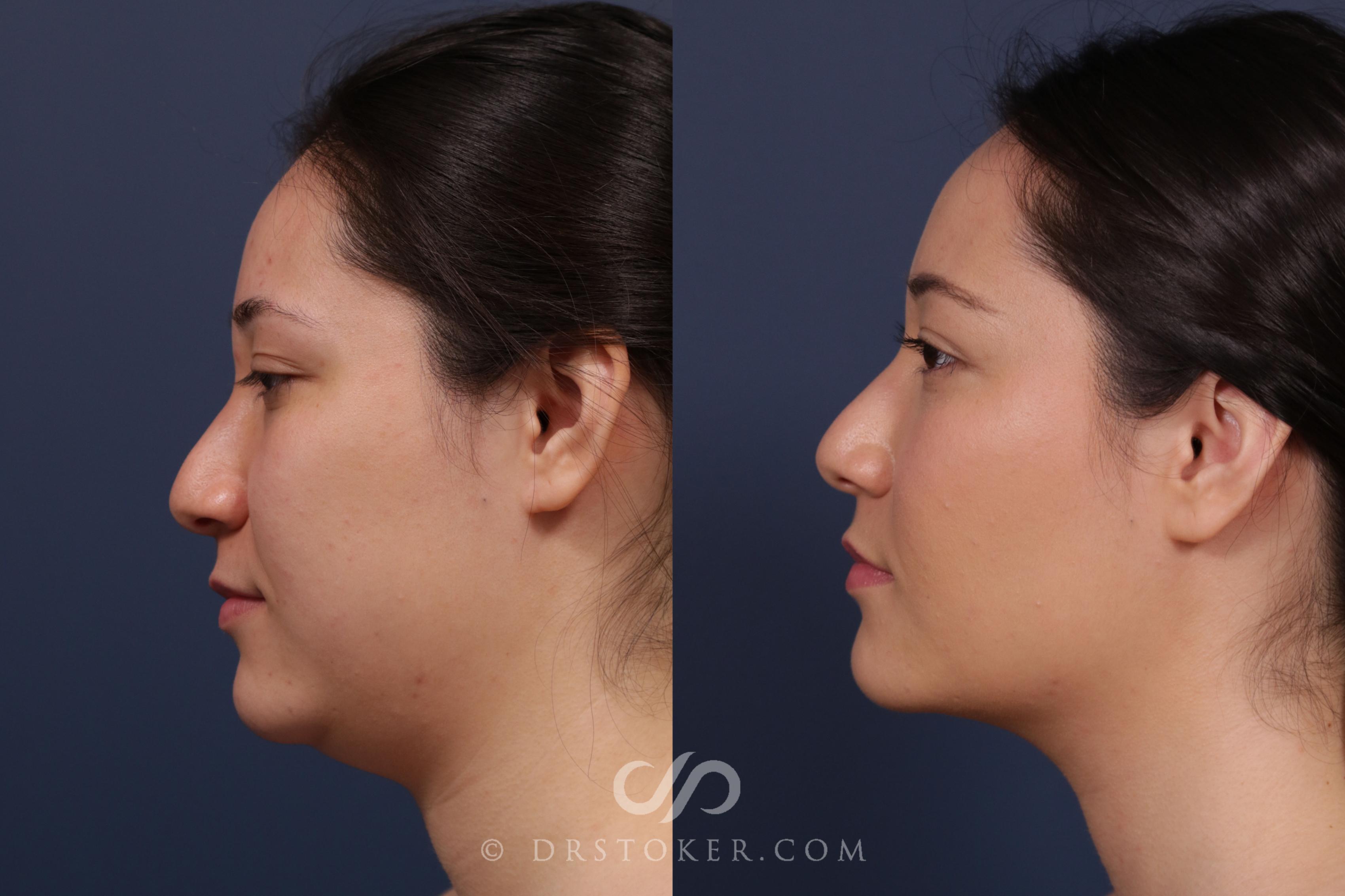 Before & After Liposuction - Neck Case 2038 Left Side View in Los Angeles, CA