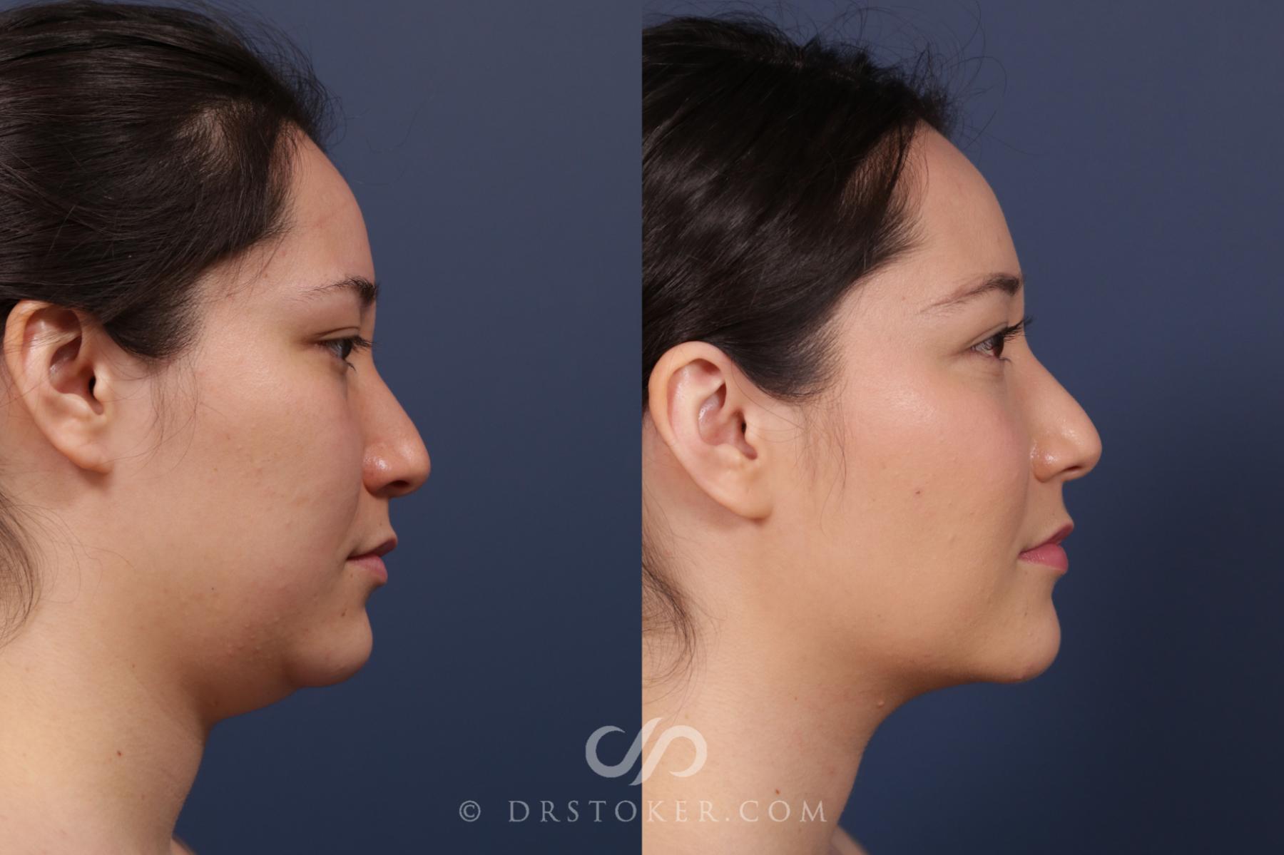 Before & After Liposuction - Neck Case 2038 Right Side View in Los Angeles, CA