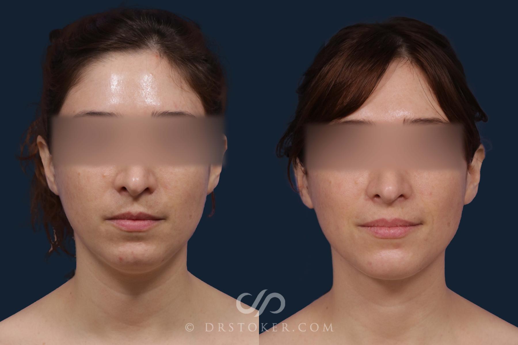 Before & After Liposuction - Neck Case 2048 Front View in Los Angeles, CA