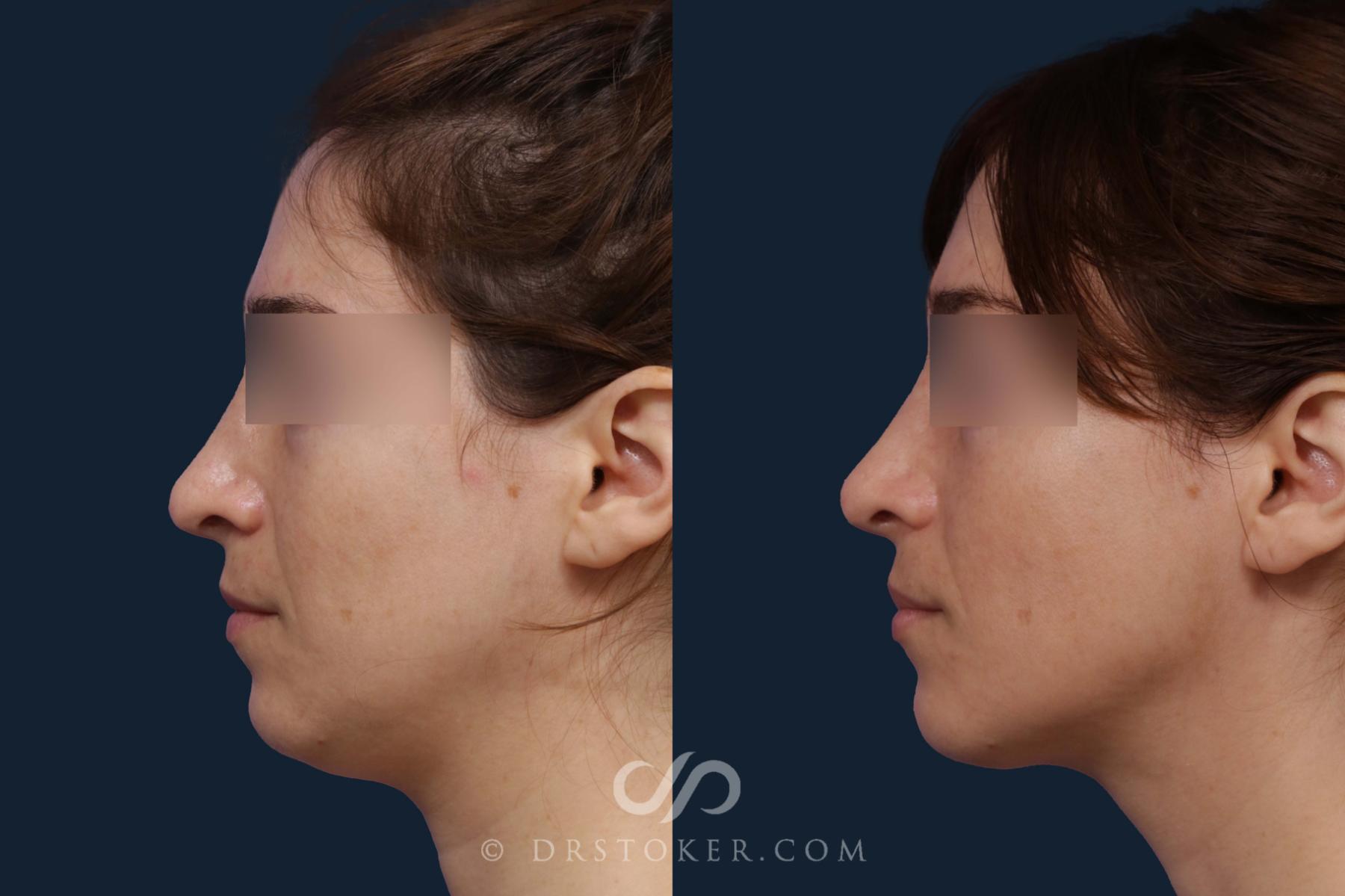 Before & After Liposuction - Neck Case 2048 Left Side View in Los Angeles, CA