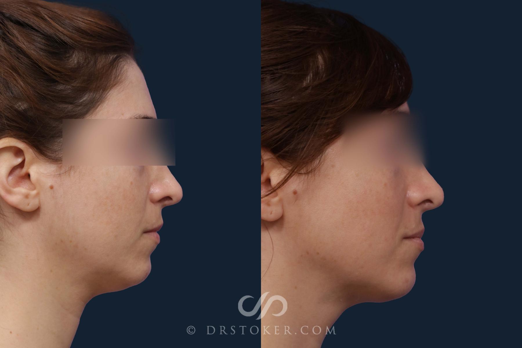 Before & After Liposuction - Neck Case 2048 Right Side View in Los Angeles, CA