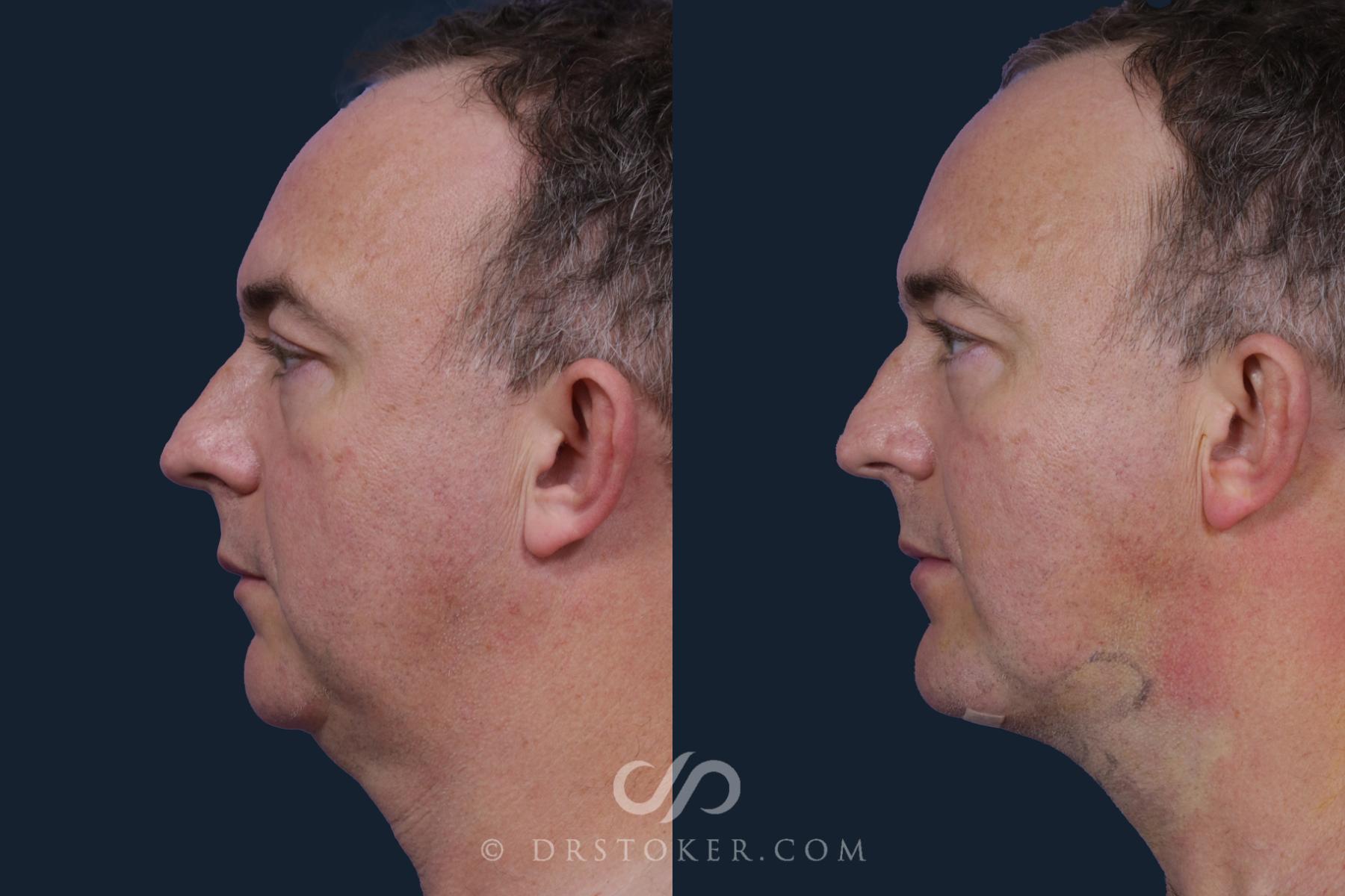 Before & After Liposuction - Neck Case 2078 Left Side View in Los Angeles, CA