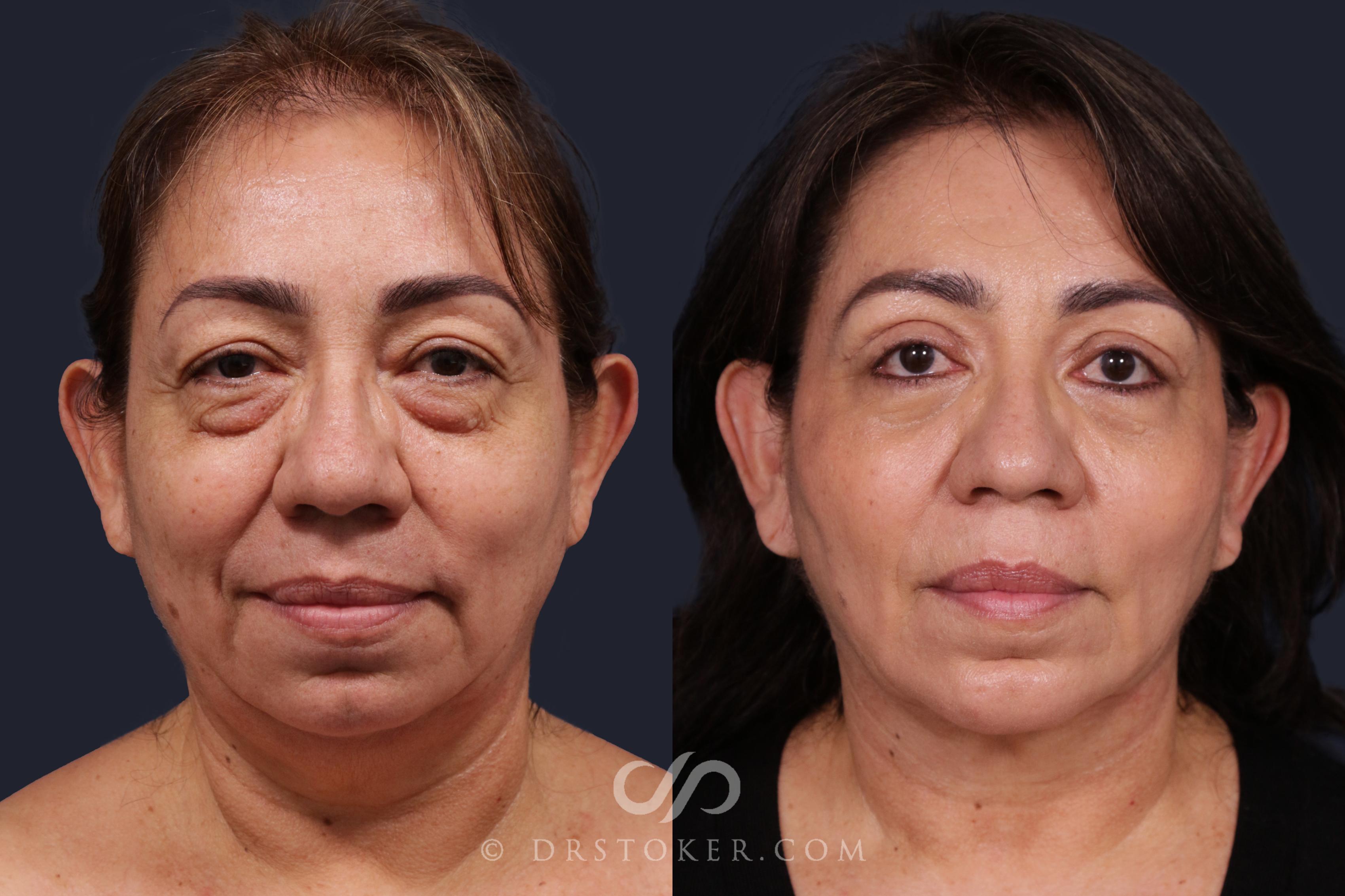 Before & After Chin Augmentation Case 2143 Front View in Los Angeles, CA