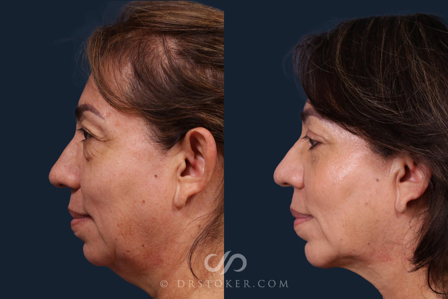 Before & After Chin Augmentation Case 2143 Left Side View in Los Angeles, CA