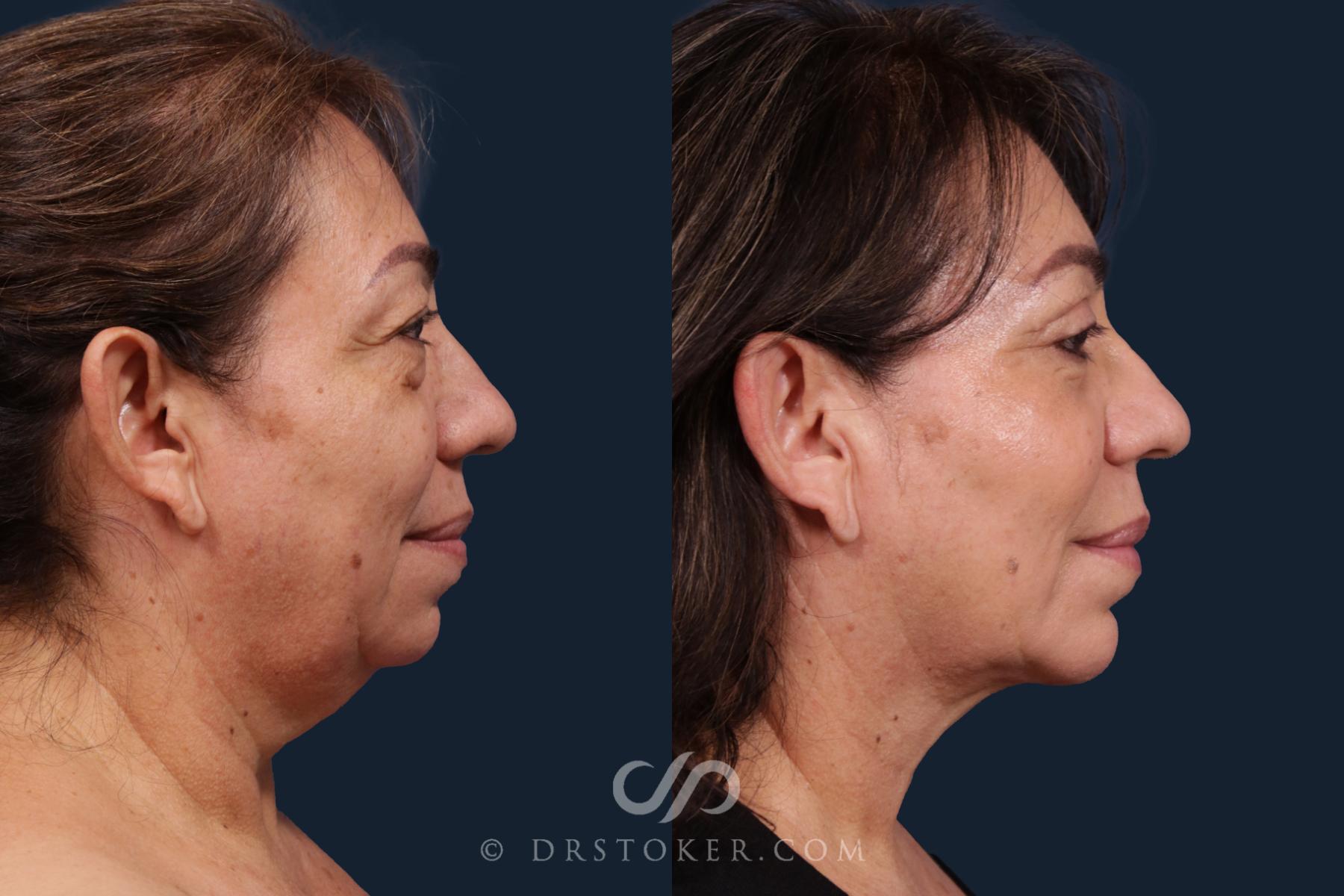 Before & After Chin Augmentation Case 2143 Right Side View in Los Angeles, CA