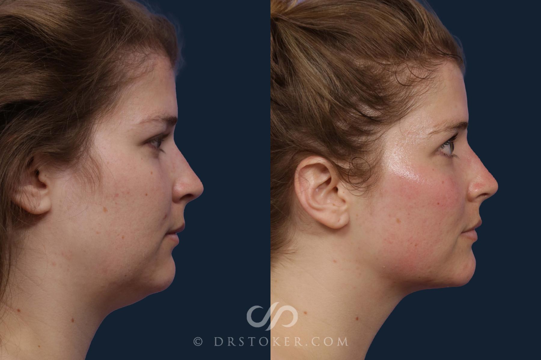 Before & After Liposuction - Neck Case 2321 Right Side View in Los Angeles, CA