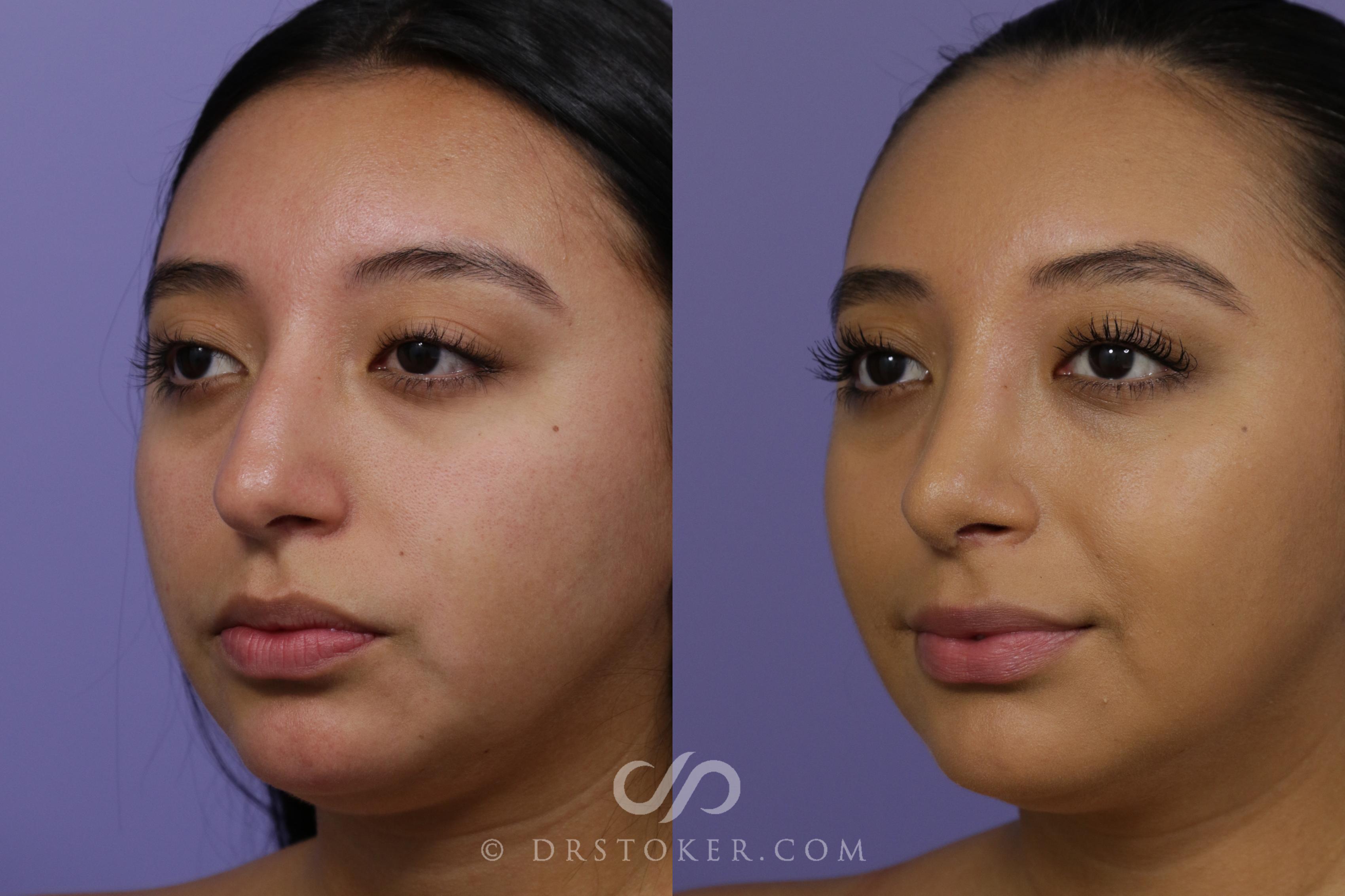 Before & After Liposuction - Neck Case 2322 Left Oblique View in Los Angeles, CA