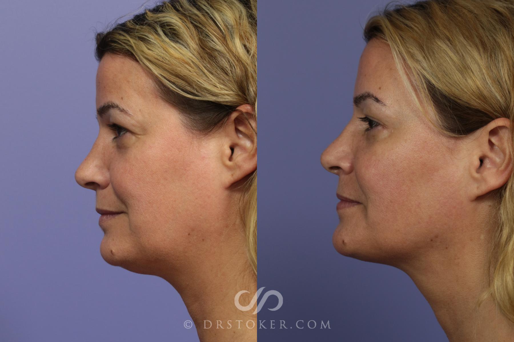 Before & After Liposuction - Neck Case 994 View #1 View in Los Angeles, CA