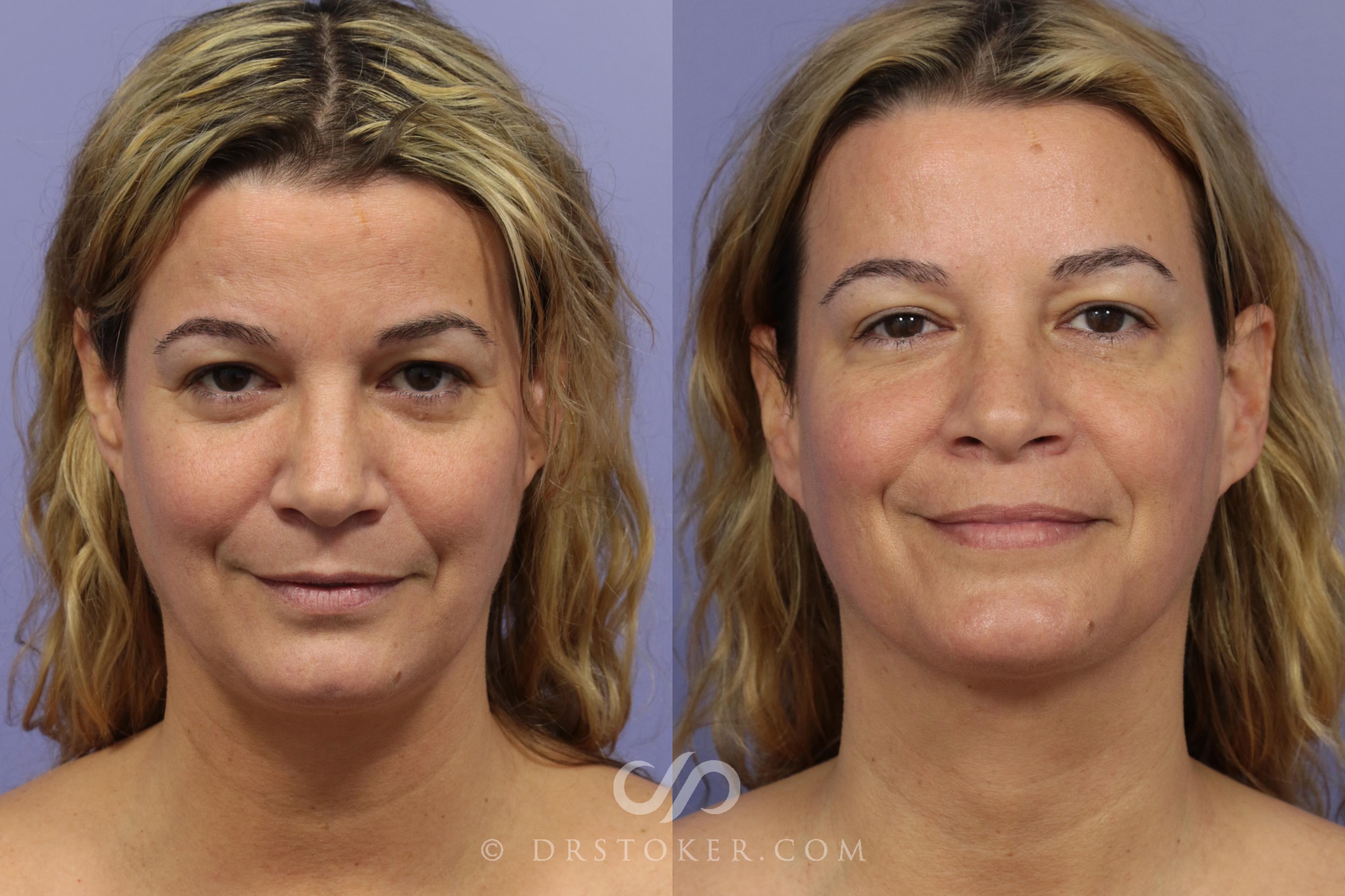 Before & After Liposuction - Neck Case 995 View #1 View in Marina del Rey, CA