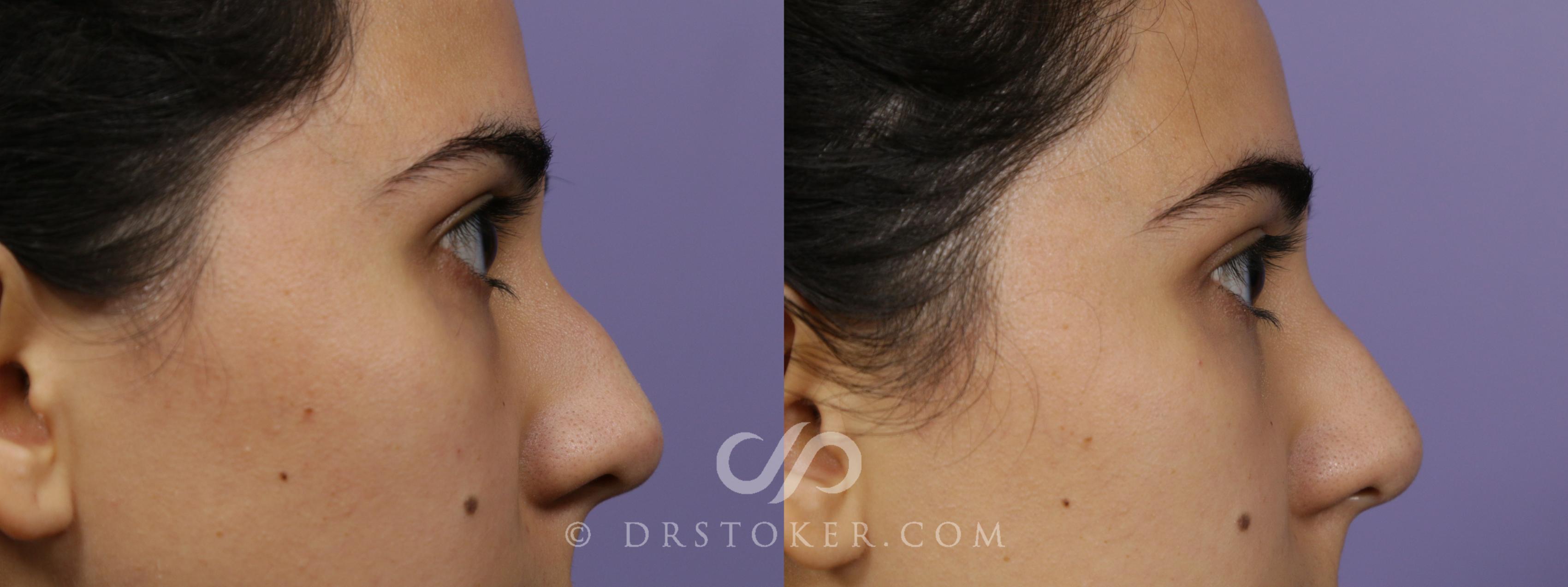 Before & After Liquid Rhinoplasty Case 1642 View #1 View in Los Angeles, CA