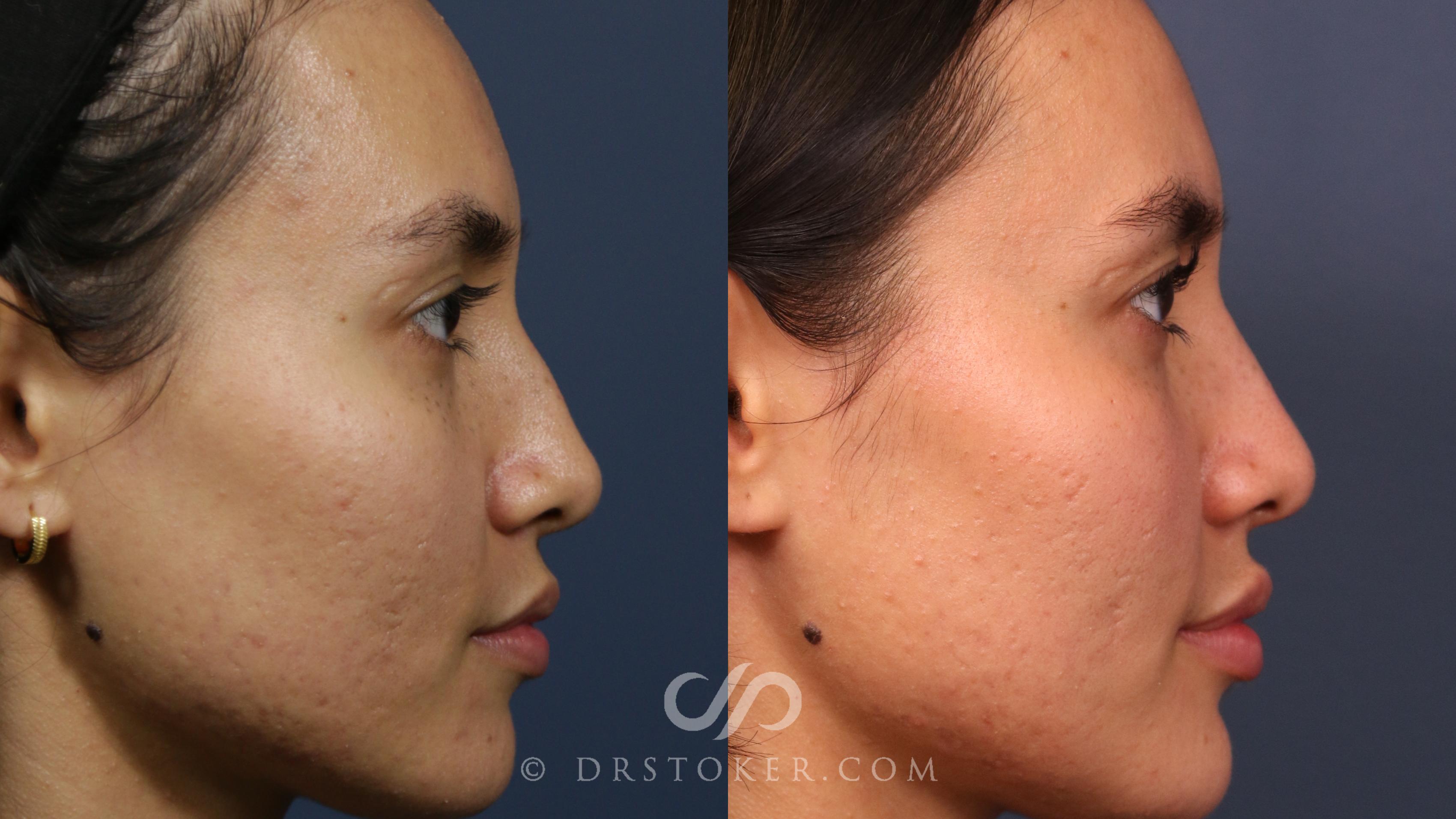 Before & After Liquid Rhinoplasty Case 2267 Right Side View in Los Angeles, CA