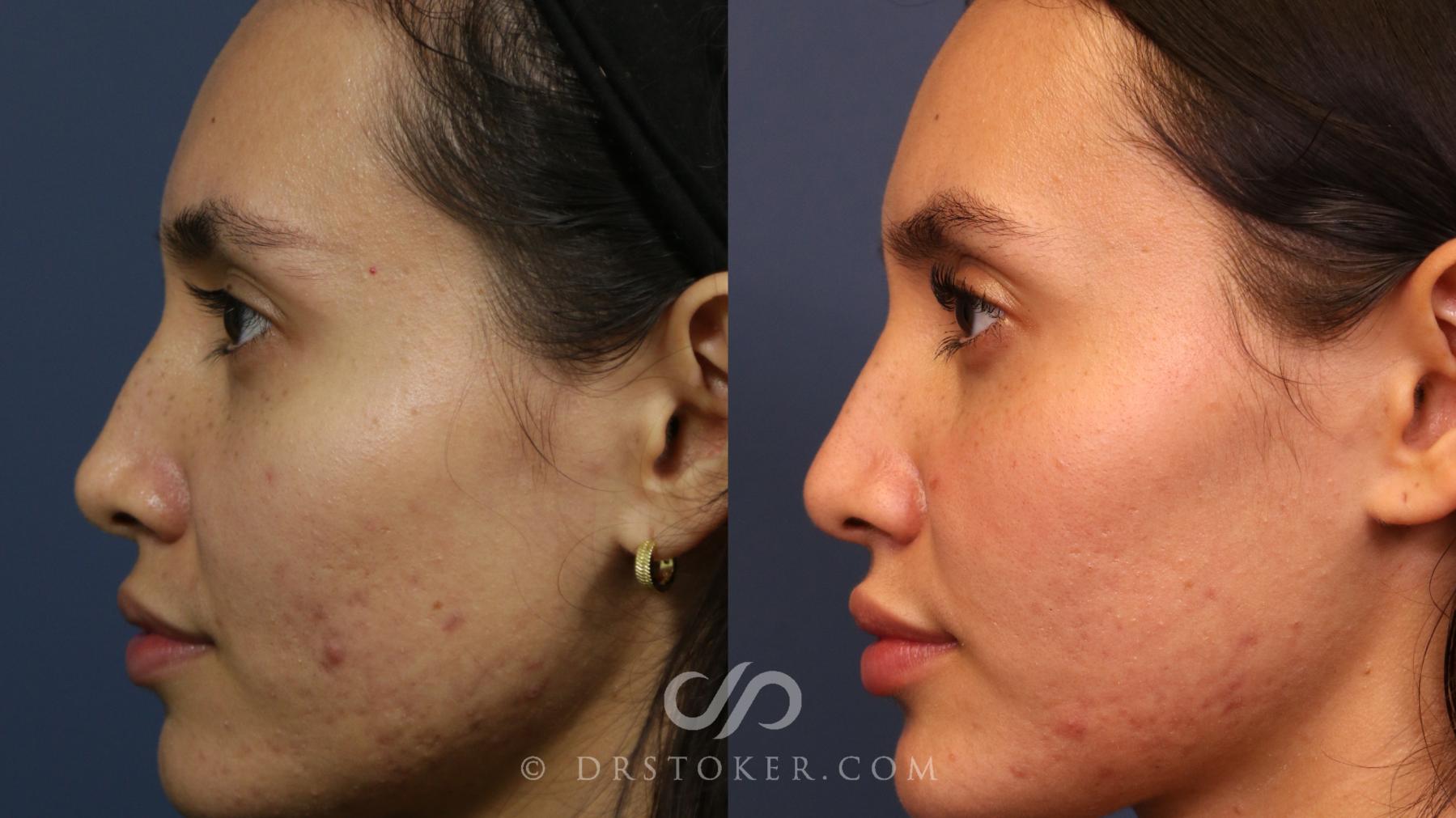 Before & After Liquid Rhinoplasty Case 2268 Left Side View in Los Angeles, CA