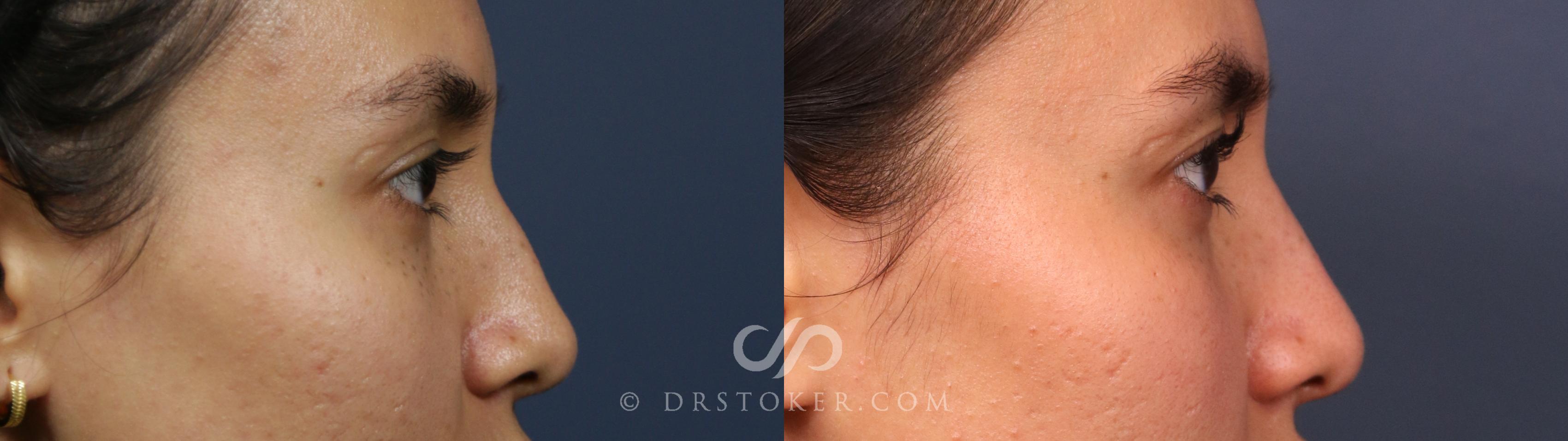 Before & After Liquid Rhinoplasty Case 2269 Right Side View in Los Angeles, CA