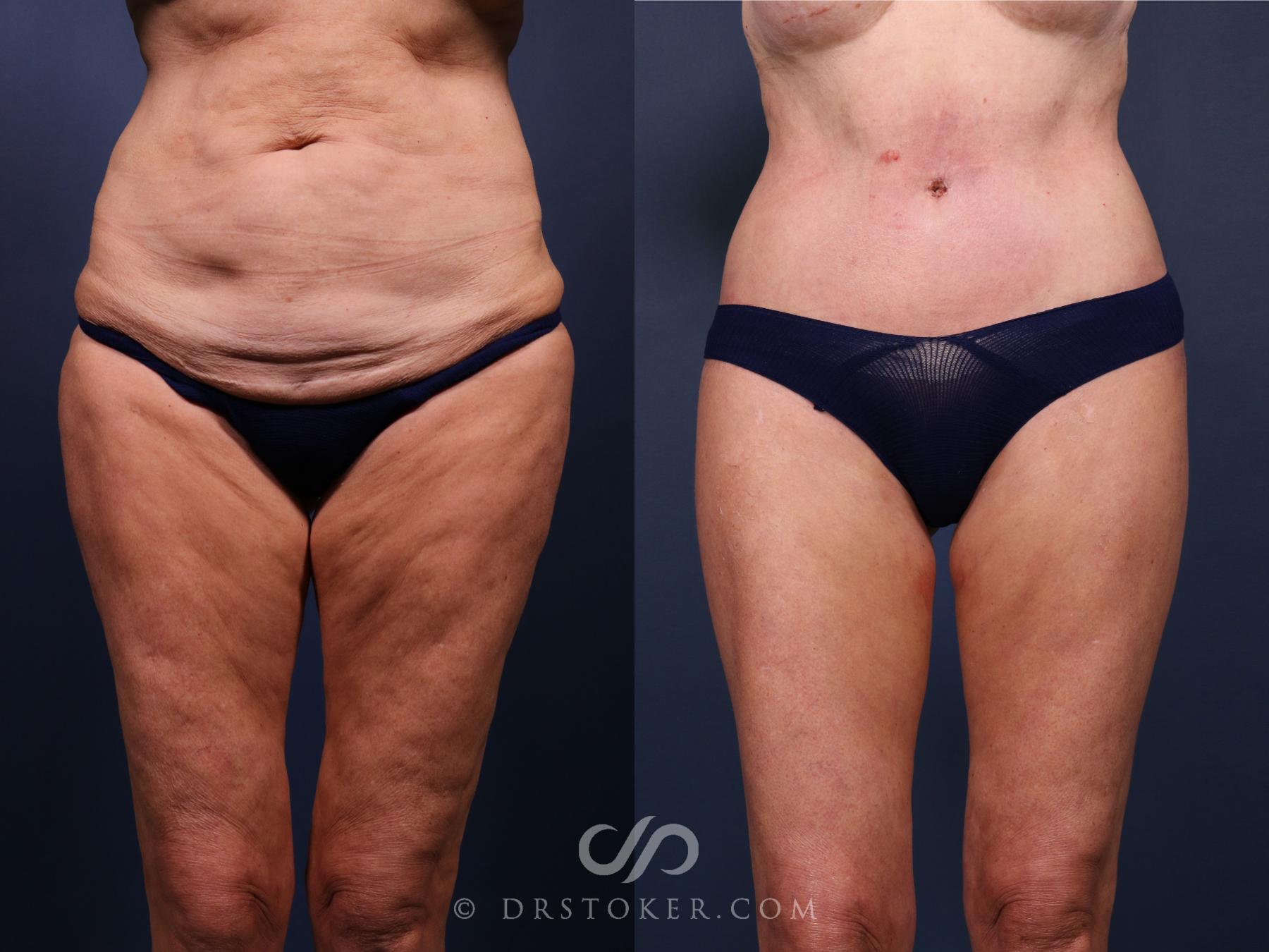 Before & After Lower Body Lift Case 2333 Front View in Los Angeles, CA