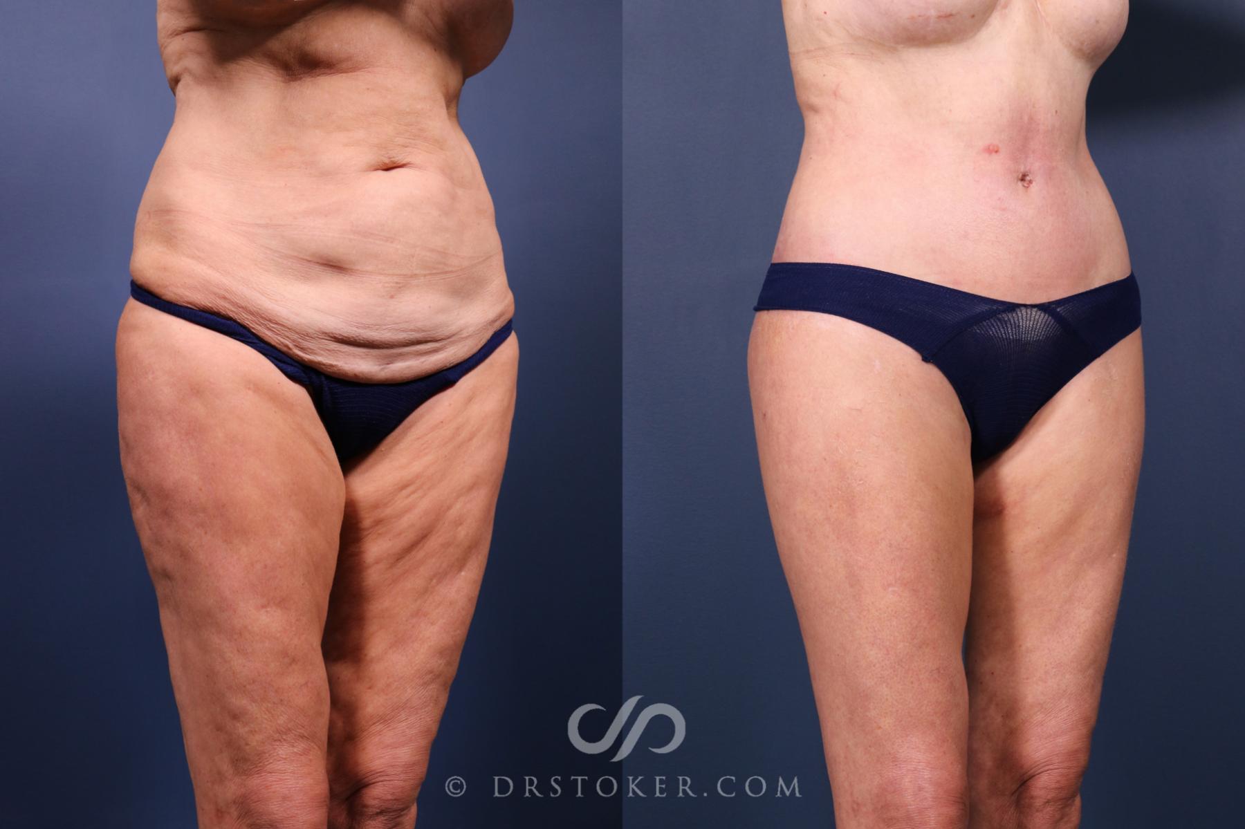 Before & After Lower Body Lift Case 2333 Right Oblique View in Los Angeles, CA