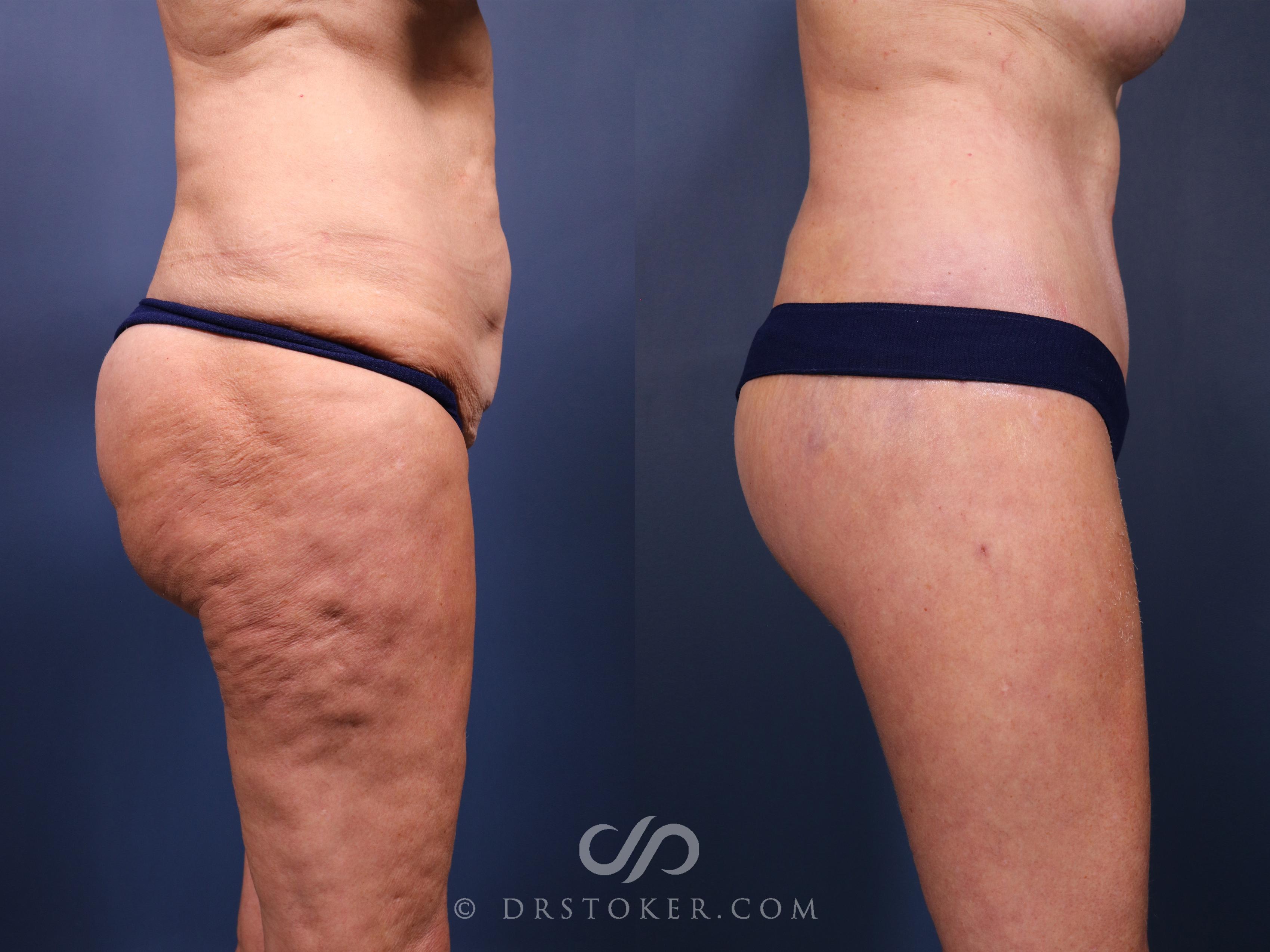 Before & After Thigh lift Case 2333 Right Side View in Los Angeles, CA