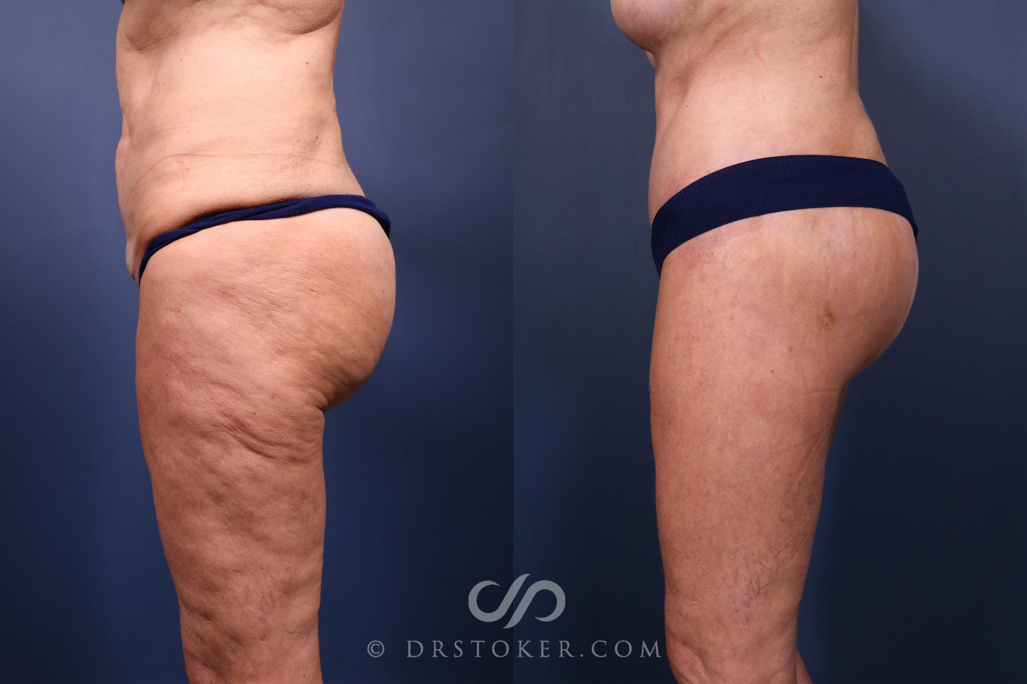 Before & After Lower Body Lift Case 2334 Left Oblique View in Los Angeles, CA