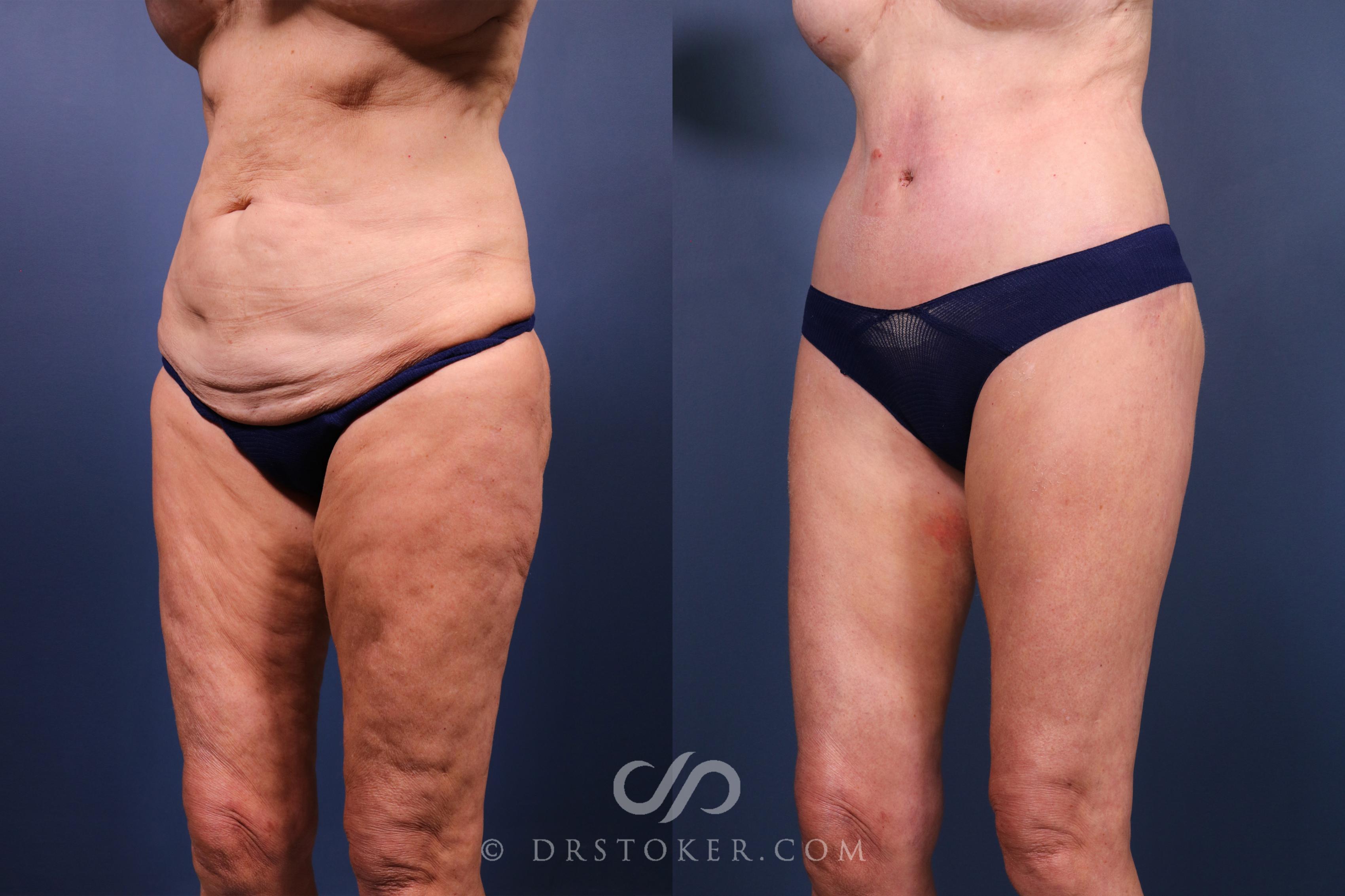 Before & After Lower Body Lift Case 2334 Left Side View in Los Angeles, CA