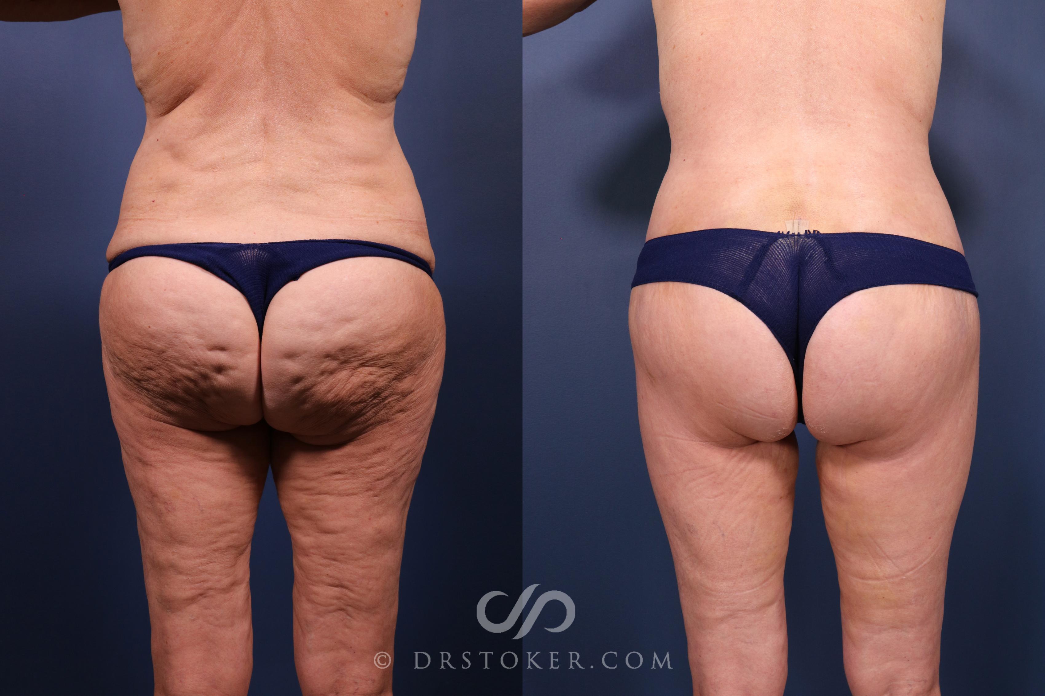 Before & After Lower Body Lift Case 2335 Back View in Los Angeles, CA