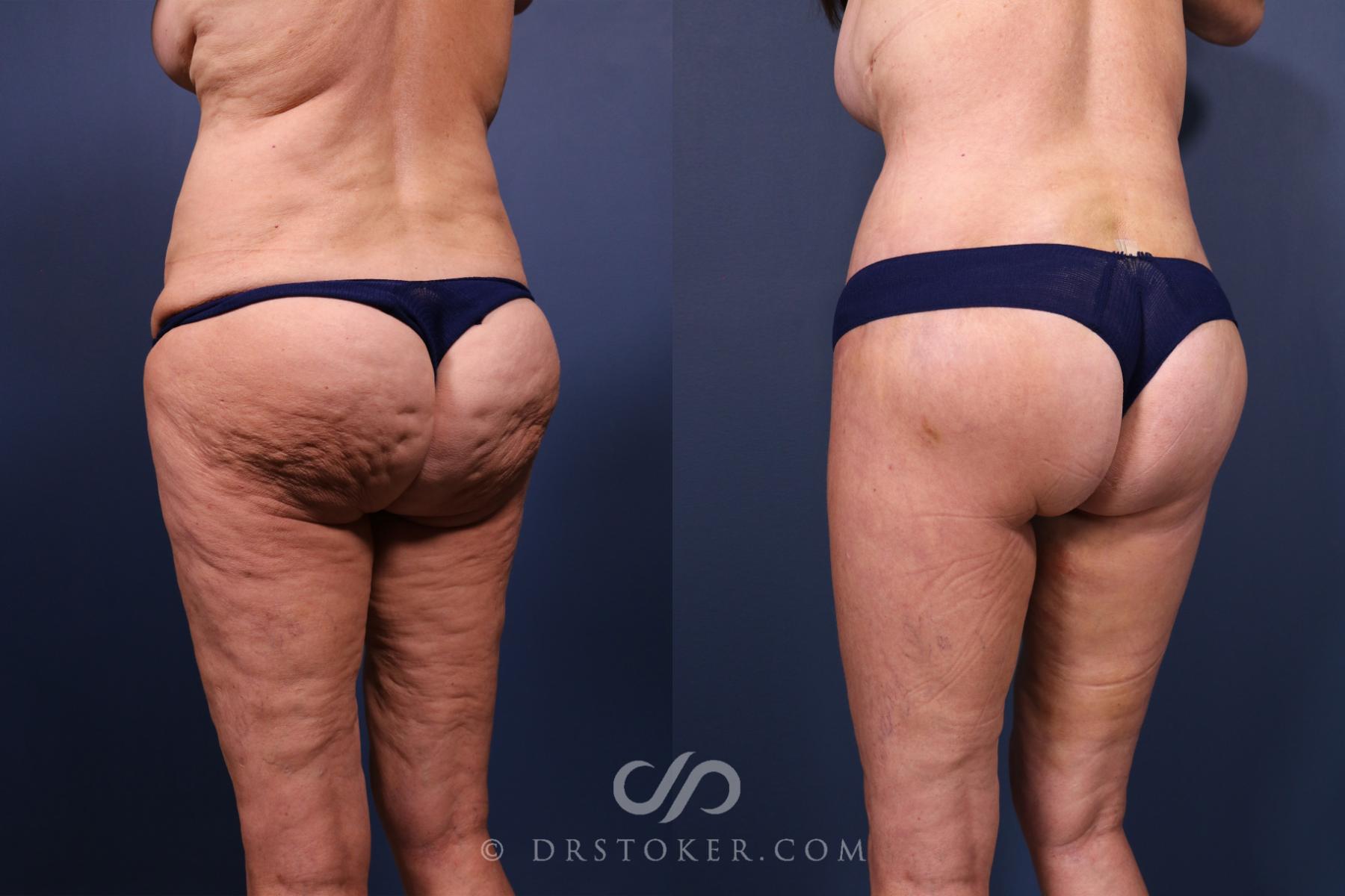 Before & After Lower Body Lift Case 2335 Left Oblique View in Los Angeles, CA