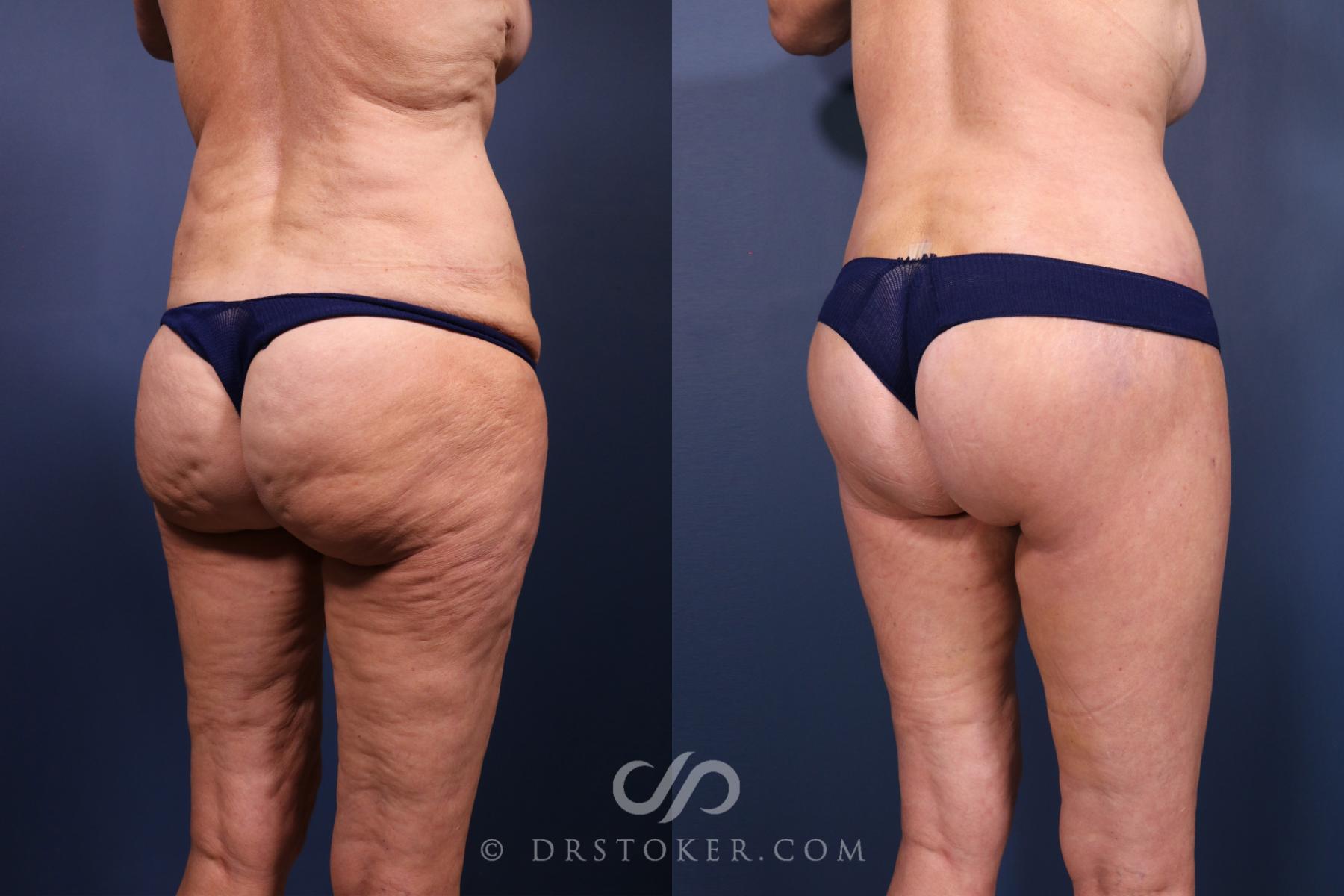 Before & After Lower Body Lift Case 2335 Right Oblique View in Los Angeles, CA