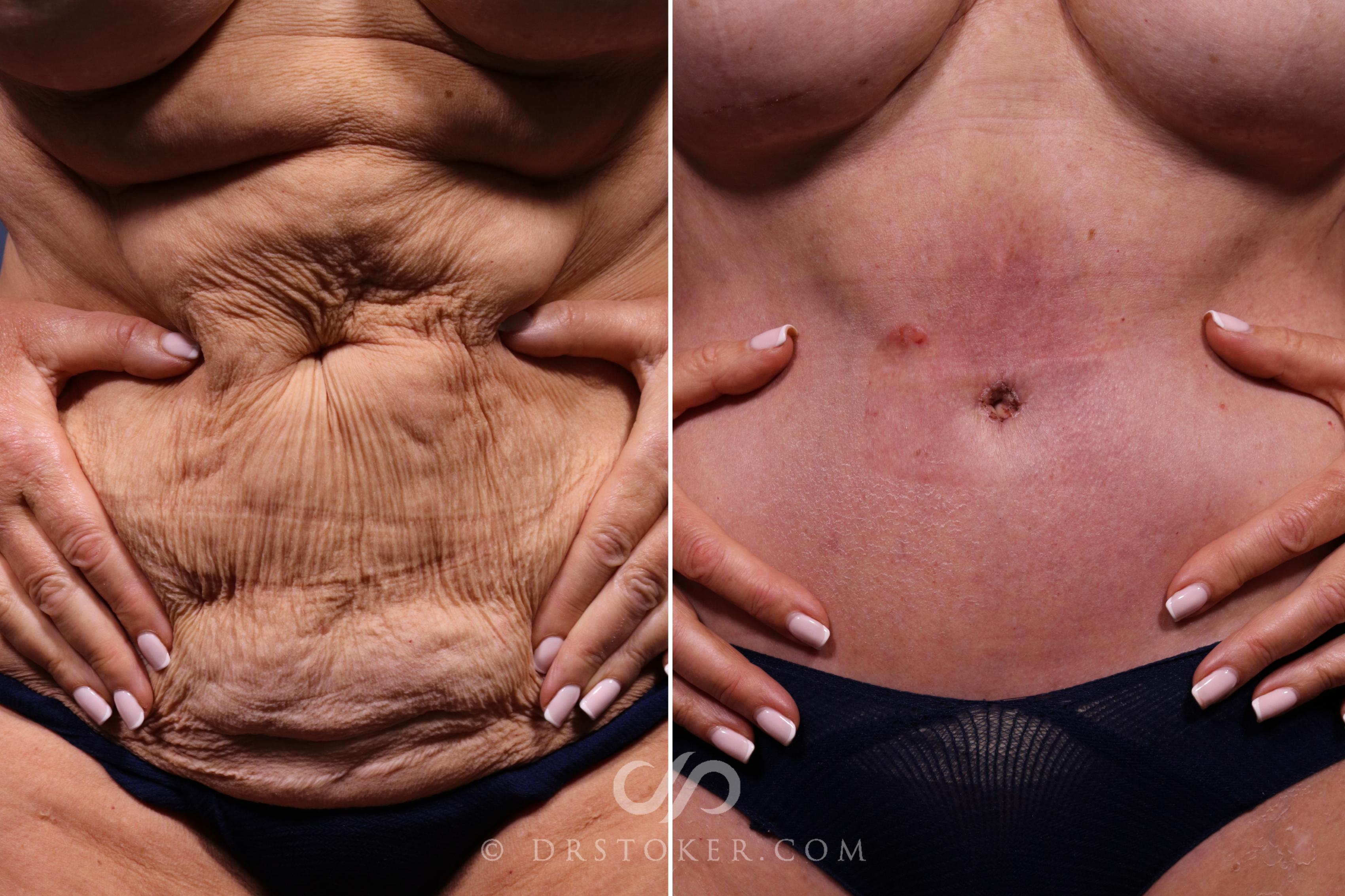 Before & After Lower Body Lift Case 2336 Front View in Los Angeles, CA