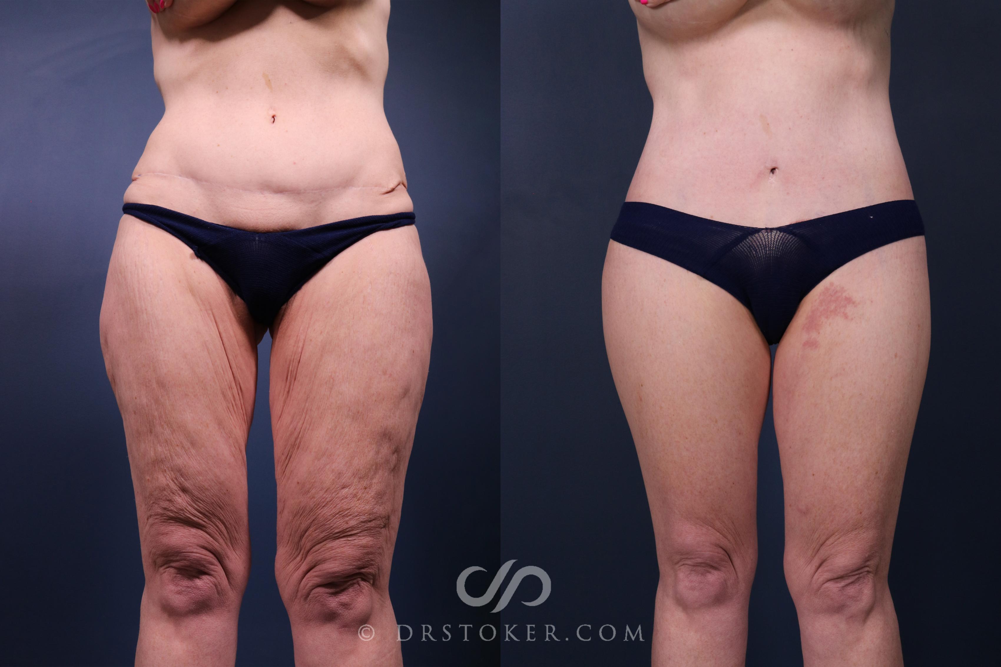 Before & After Lower Body Lift Case 2347 Front View in Los Angeles, CA