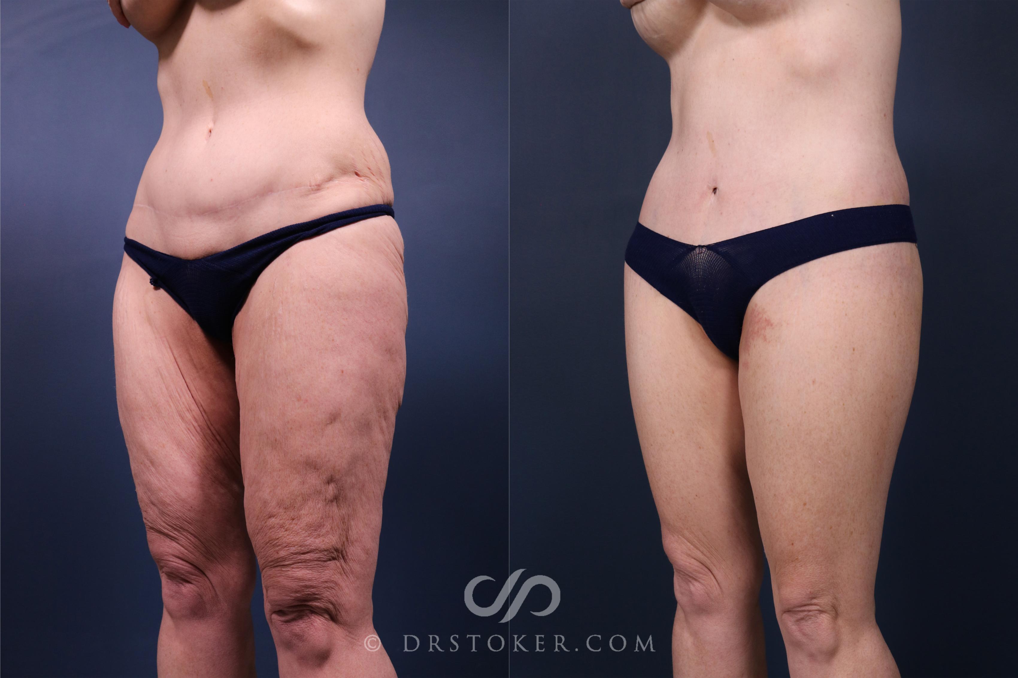 Before & After Lower Body Lift Case 2347 Left Oblique View in Los Angeles, CA