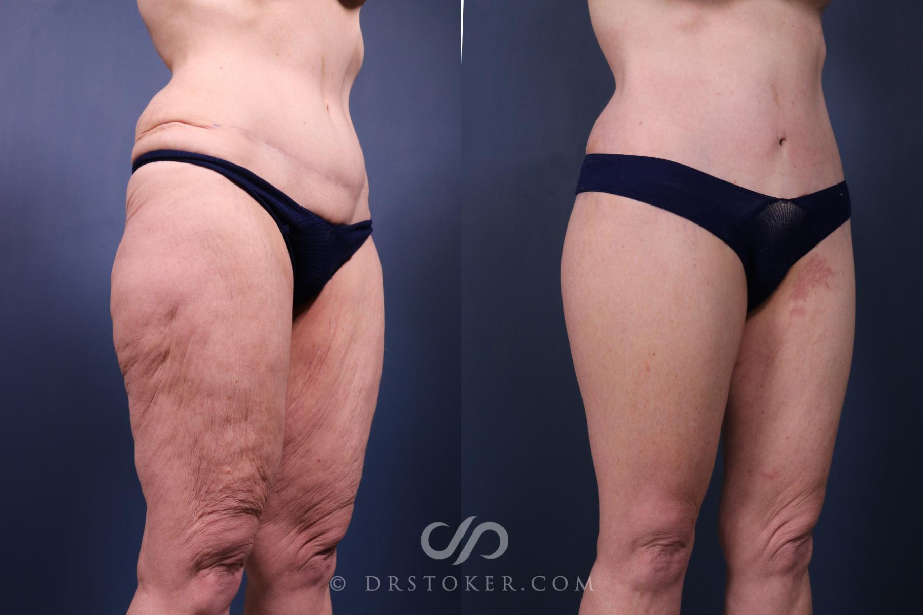 Before & After Lower Body Lift Case 2347 Right Oblique View in Los Angeles, CA