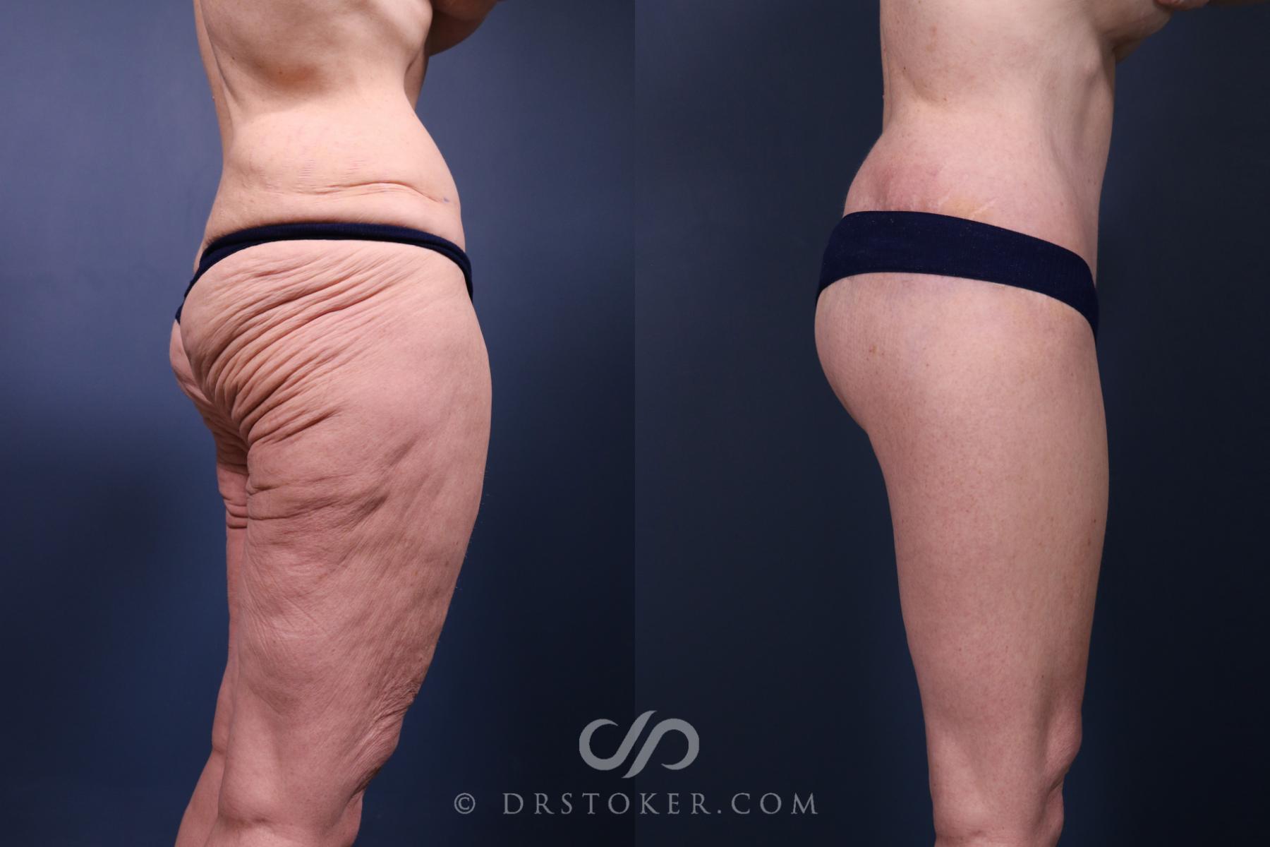 Before & After Lower Body Lift Case 2347 Right Side View in Los Angeles, CA