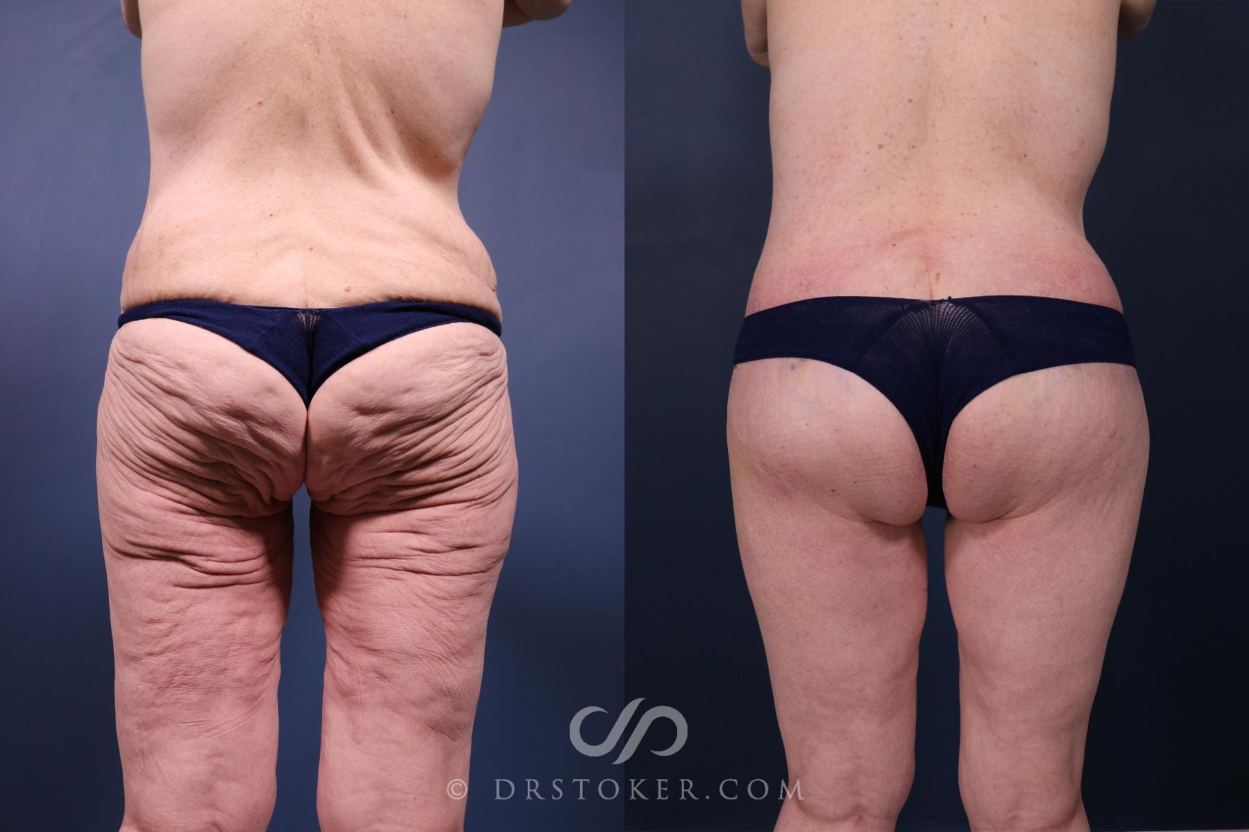 Before & After Lower Body Lift Case 2348 Back View in Los Angeles, CA