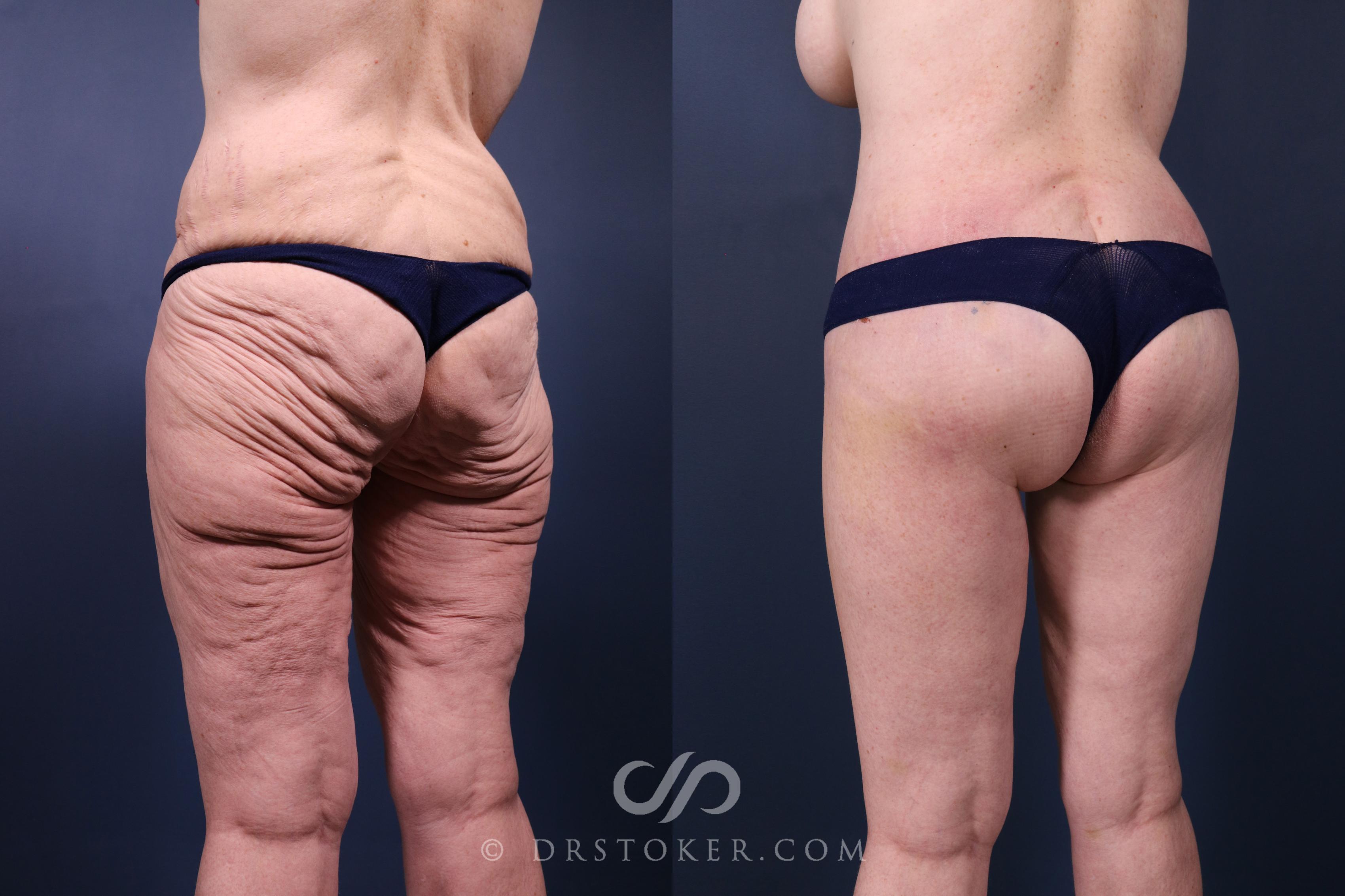 Before & After Lower Body Lift Case 2348 Left Oblique View in Los Angeles, CA